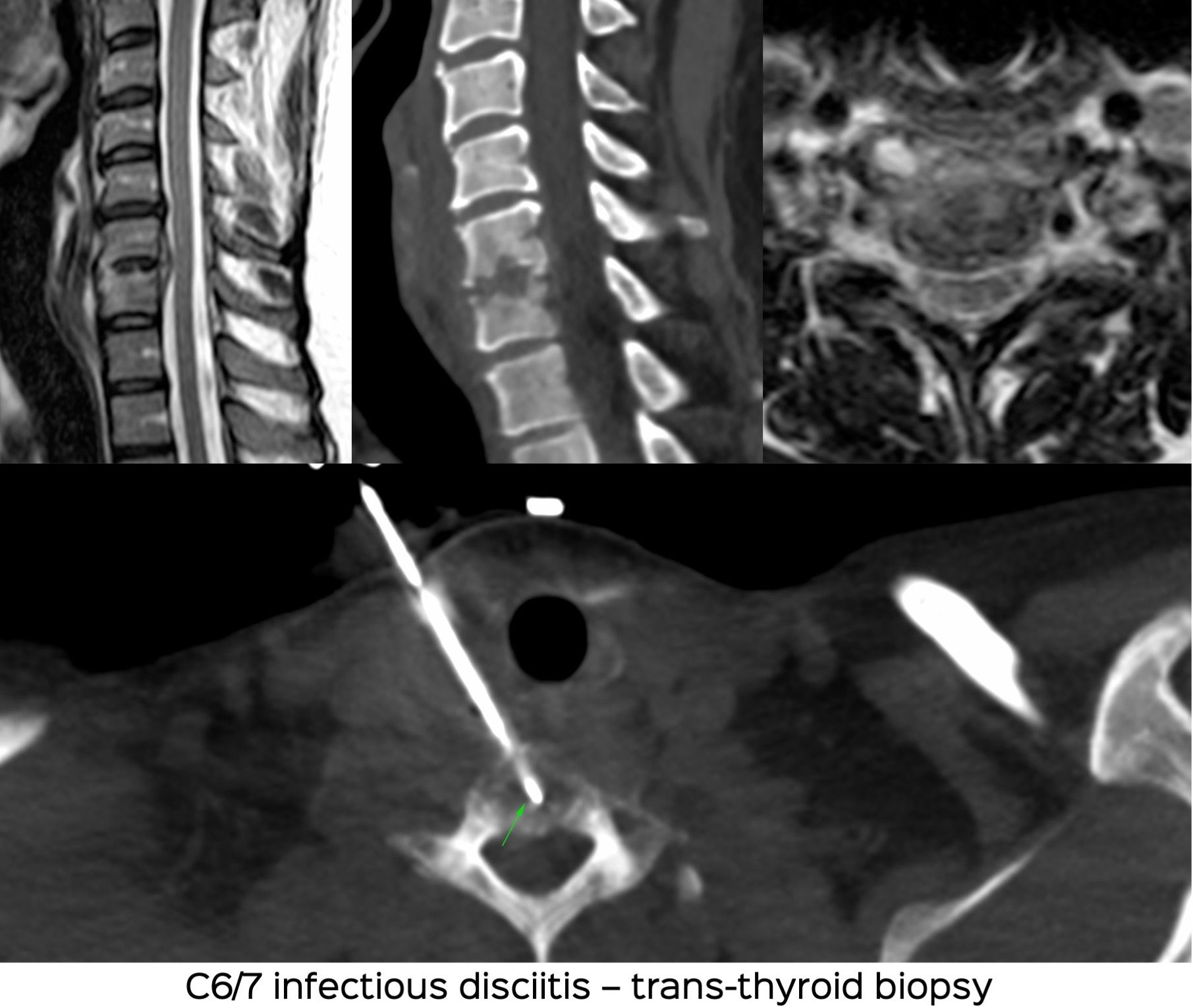 Case 25: Trans-Thyroid Cervical Spine Biopsy for Infective Disciitis