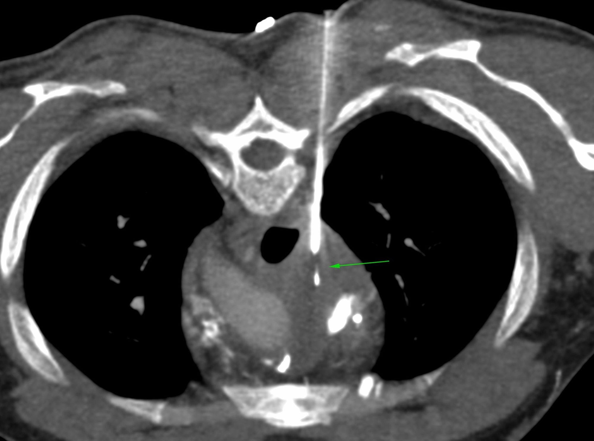 Case 50: When the "Feel" of the Lesion Gives The Diagnosis - Right Paratracheal Mediastinal Mass Biopsy with an Extrapleural Approach - Mediastinal Fibrosis
