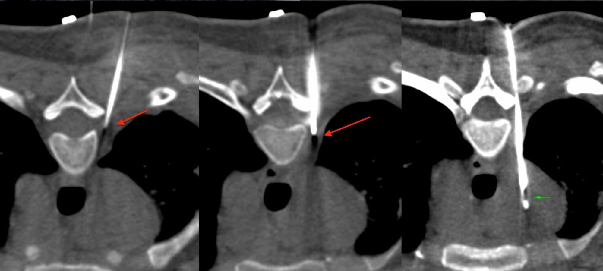 Lecture 1: The Art and Science of Mediastinal Node Biopsies