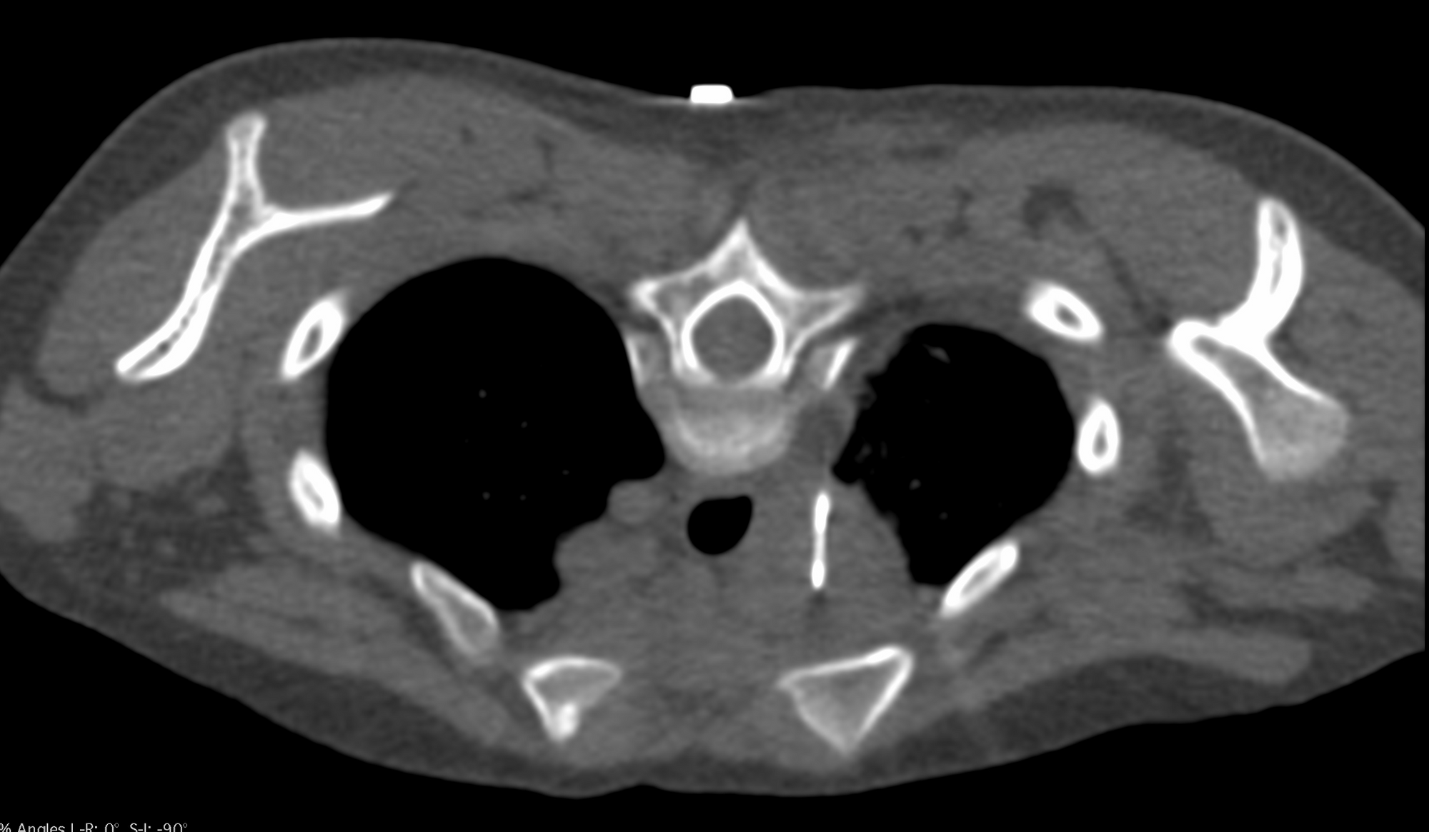 Case 1: Right Paratracheal Node Biopsy - One Stage - Pediatric