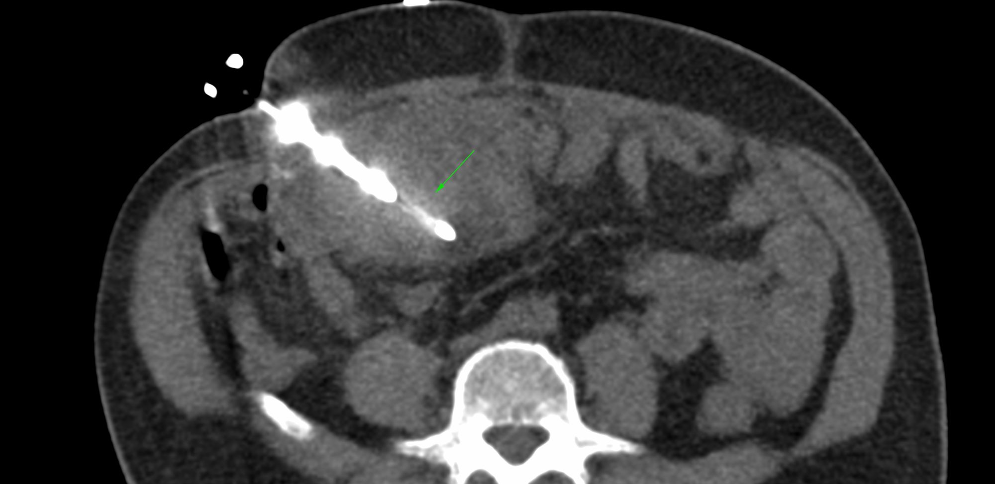 Case 5: Peritoneal & Omental Masses
