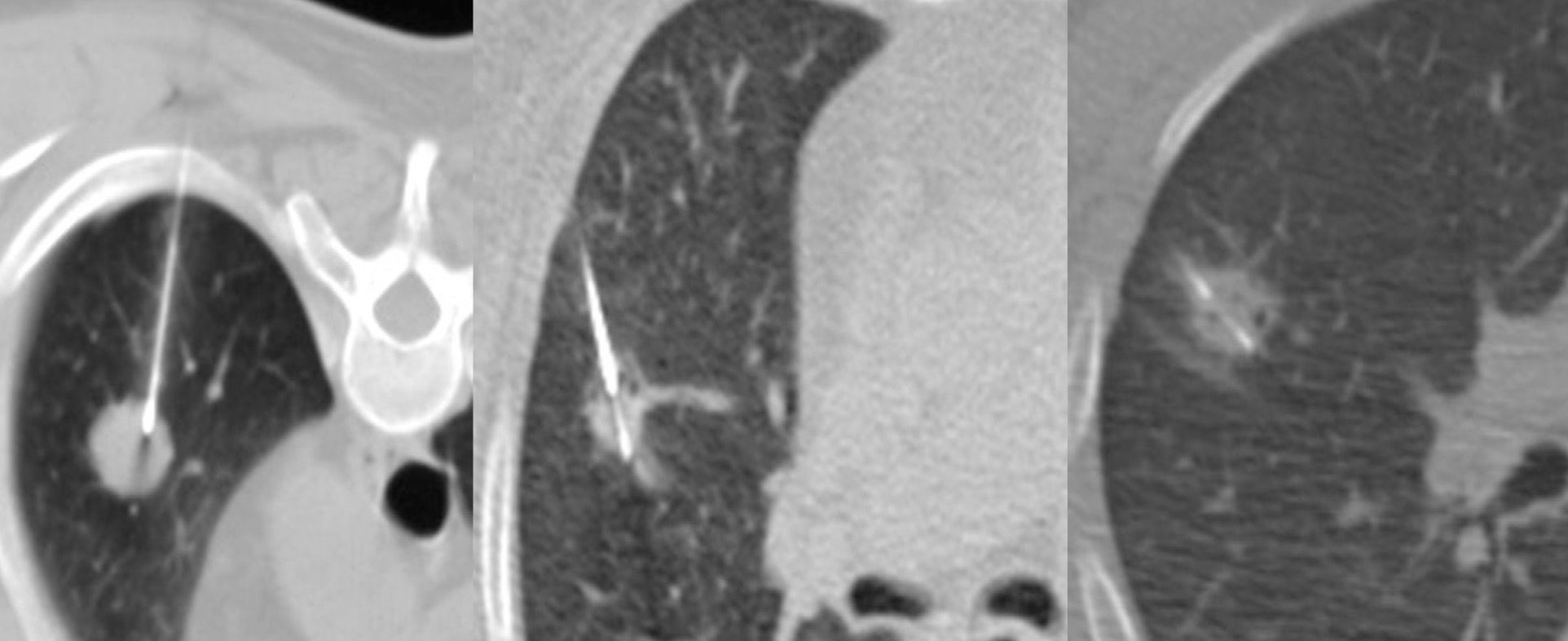 Lecture: Approach to MSK Biopsies