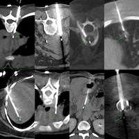 CT Guided Biopsy