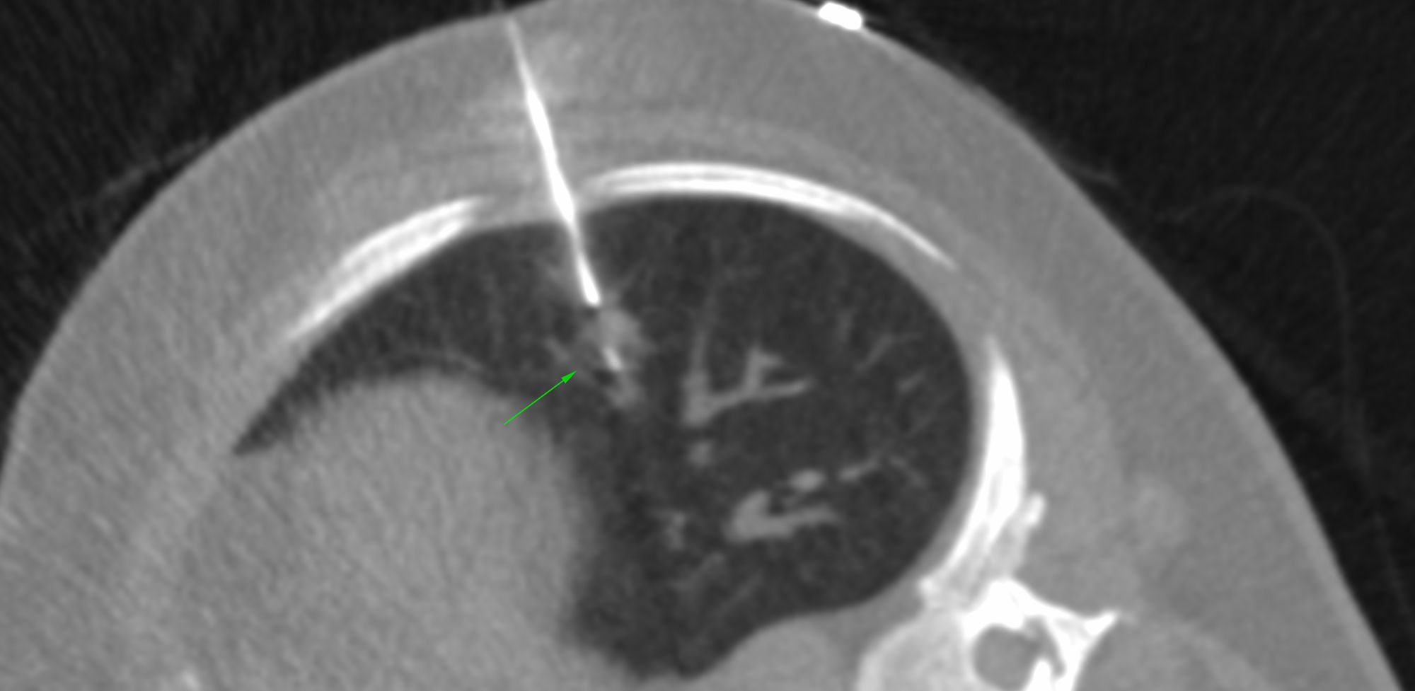 Case 2: Small lung nodule - 6-10 mm (7.8 mm)