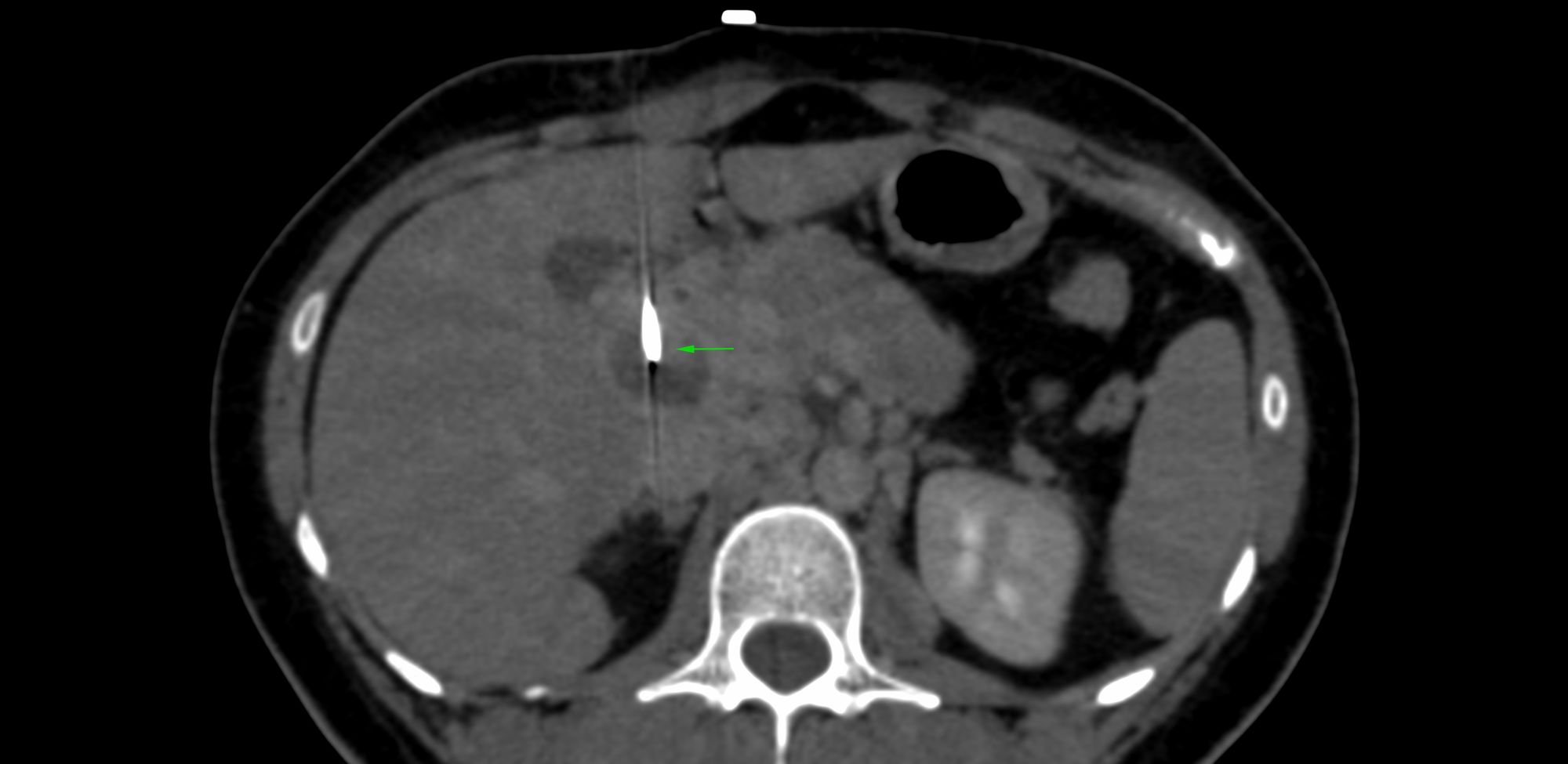 Case 4: Necrotic Portal Node, 2.9 cm