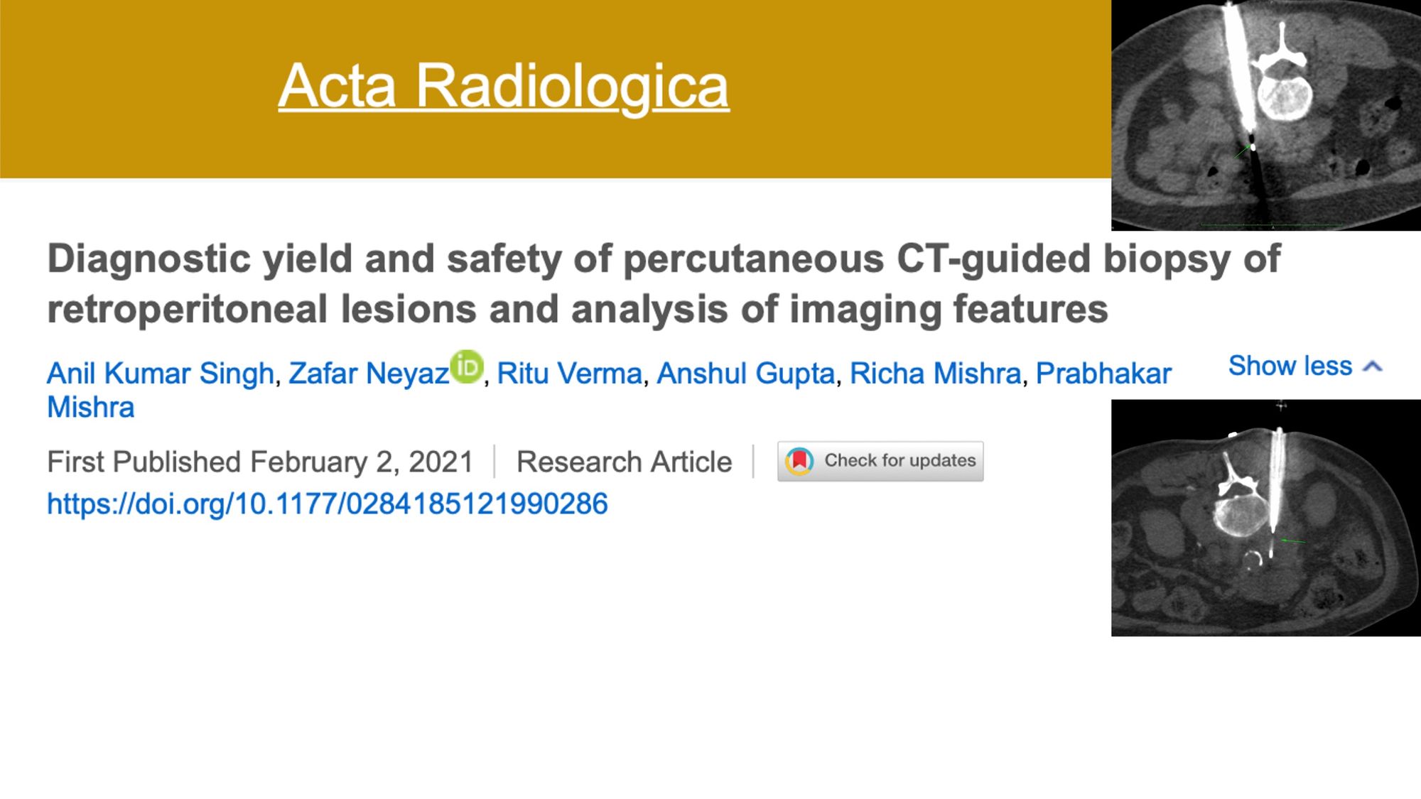 Article Review 1: CT Guided Retroperitoneal Lesion Biopsy