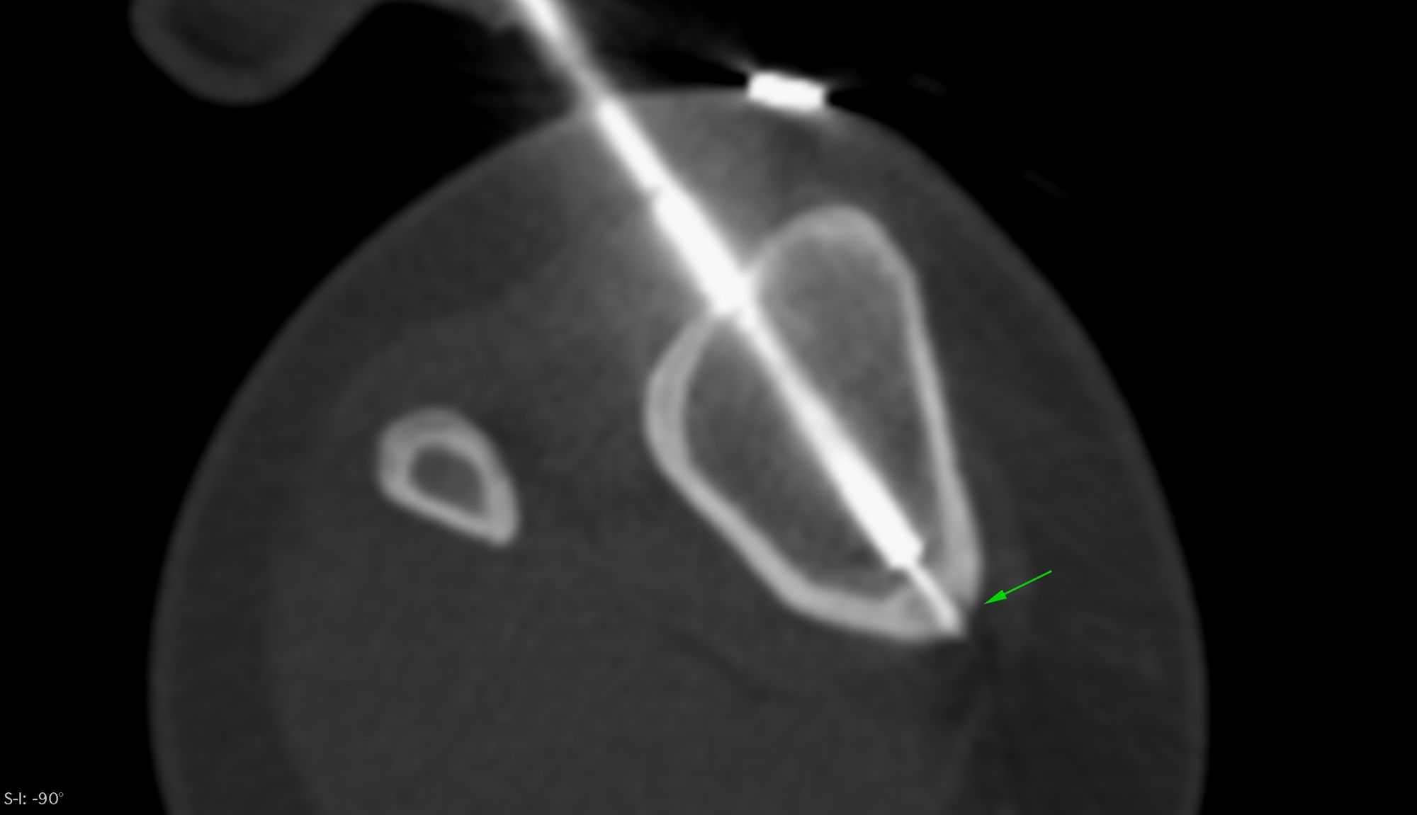 Case 7: Radiofrequency Ablation (RFA) - Tibial Osteoid Osteoma