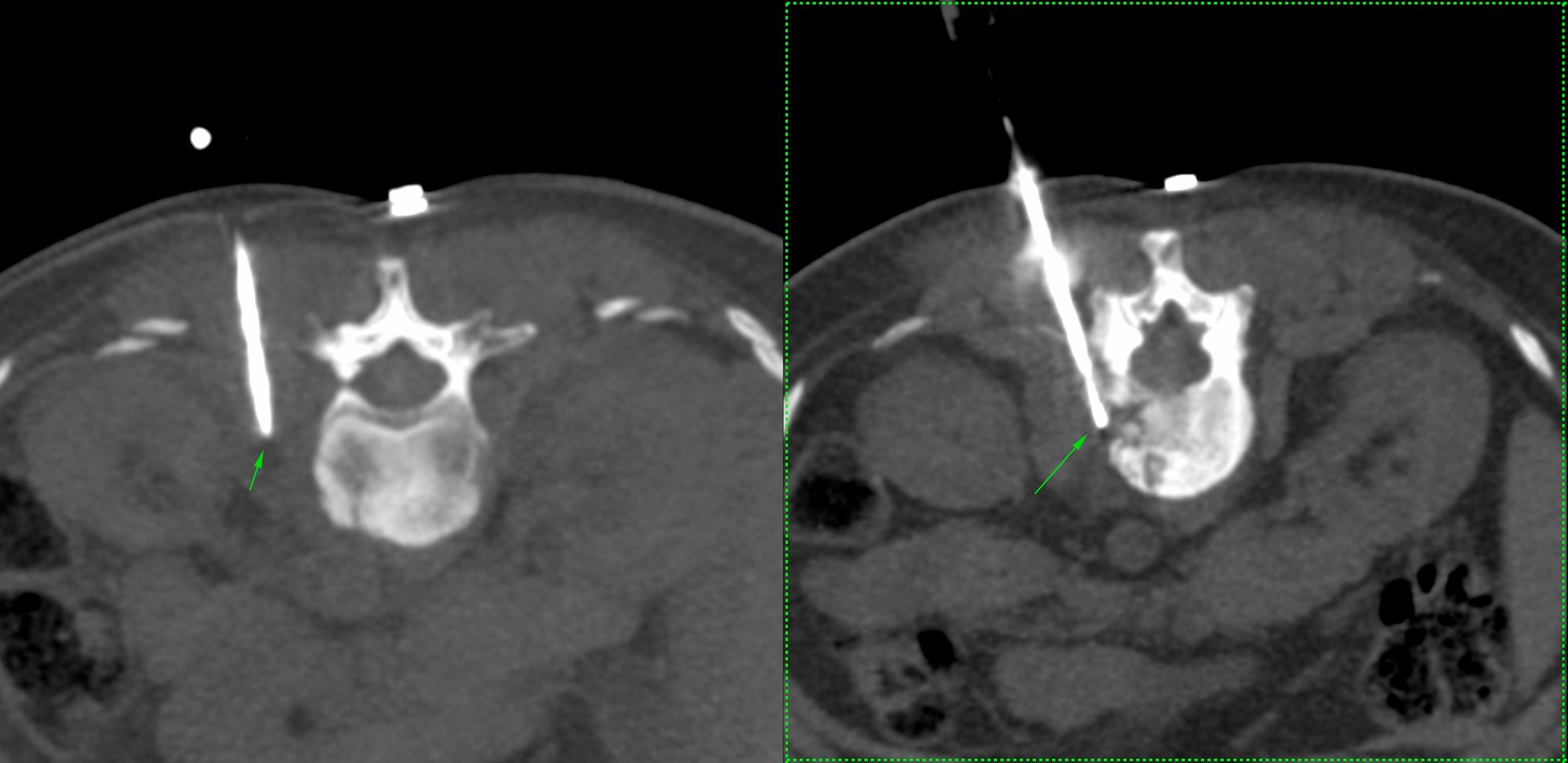 Case 3: Multifocal spine lesions - infectious spondylitis, likely tuberculosis