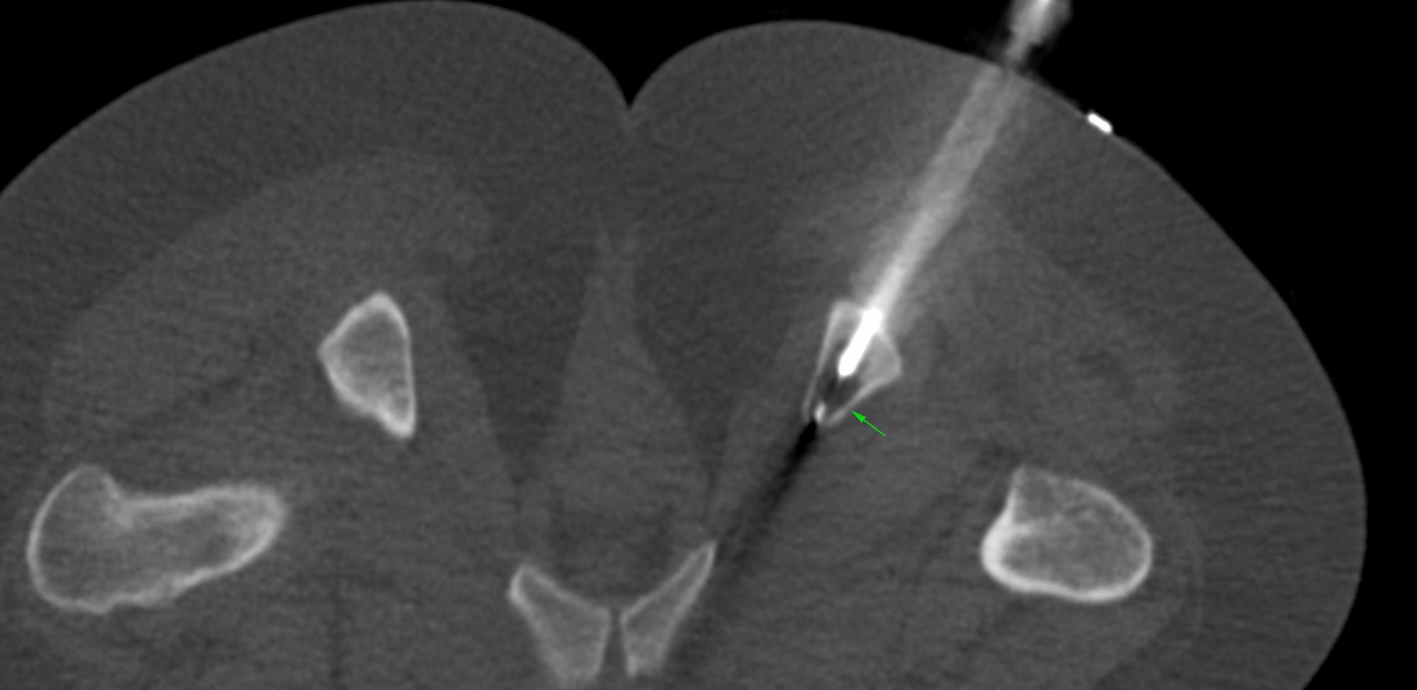 Case 10: Right Ischial Tuberosity Lesion Biopsy