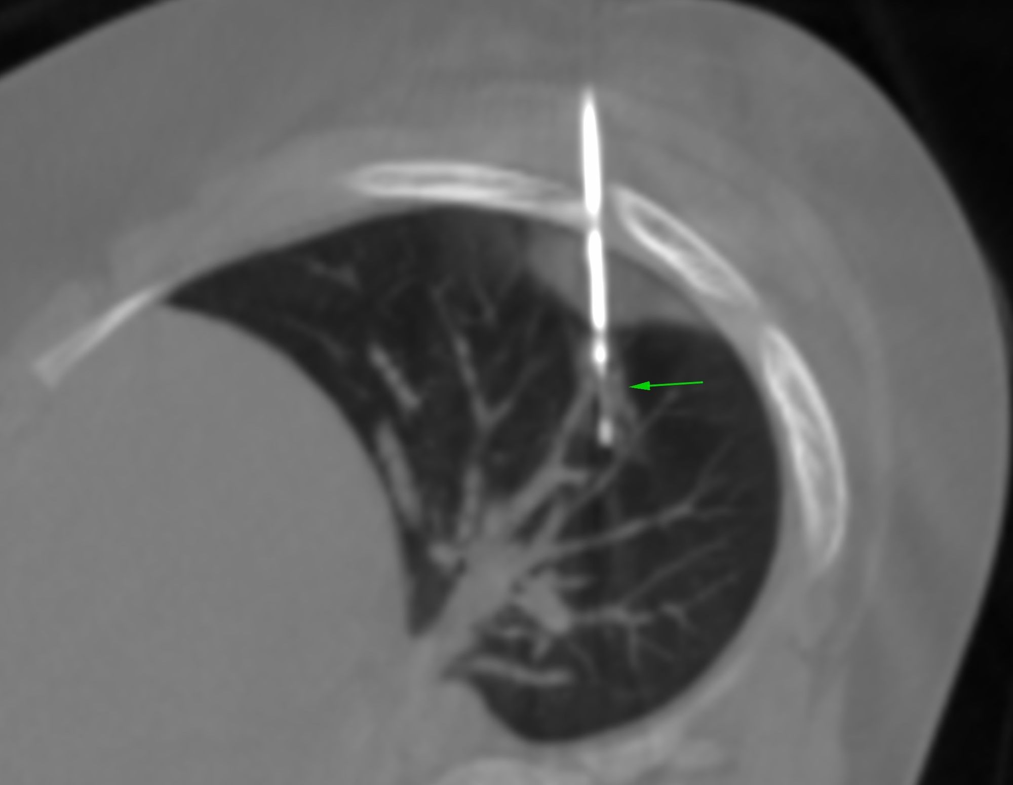 Case 16: 4.8 mm Lung Nodule in a 11-Years Old