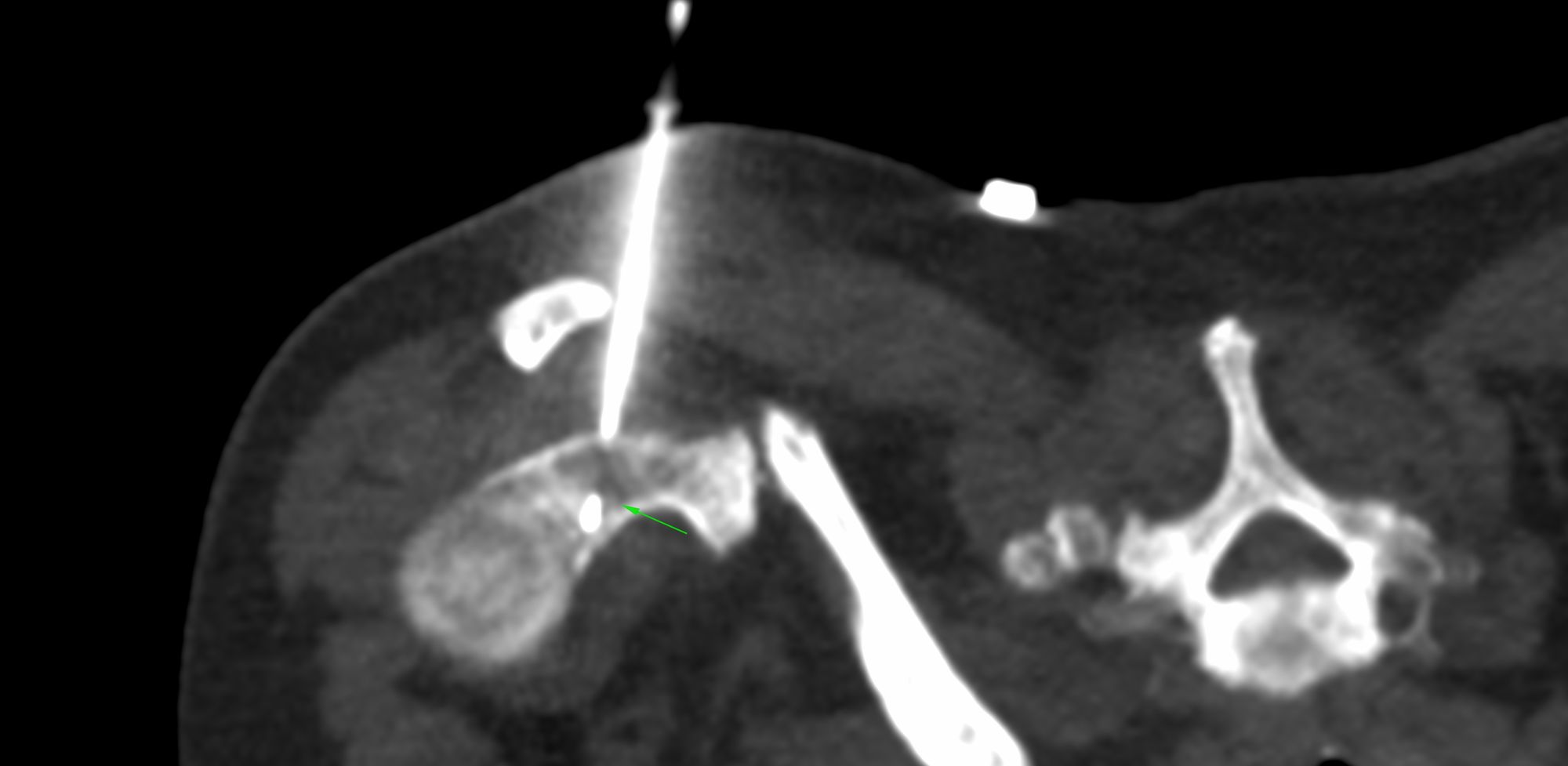 Case 13: Left Mixed Osteolytic-Osteosclerotic Glenoid Bone Lesion Biopsy