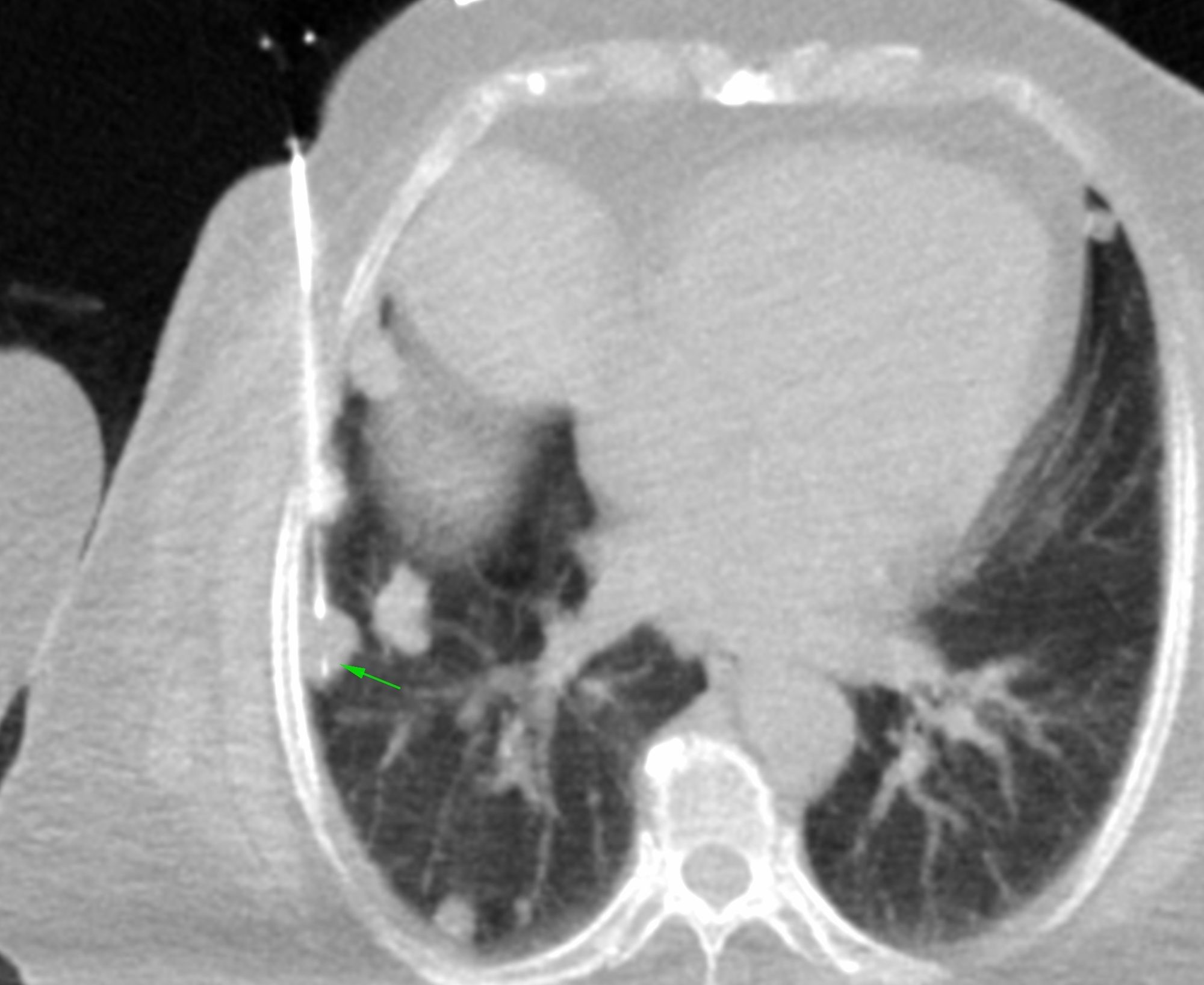 Case 17: 15 mm Lung Nodule Biopsy - Multiple Lung Nodules