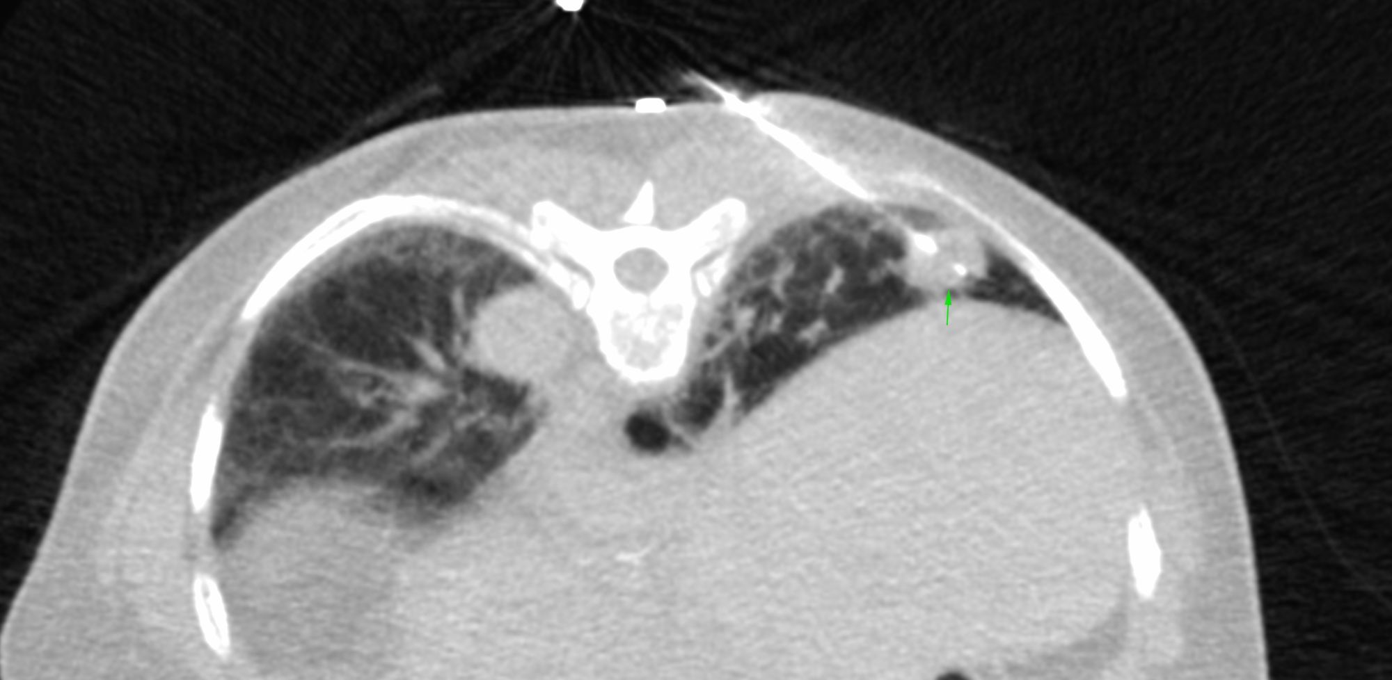 Case 15: UIP IPF with a Superimposed Lung Nodule