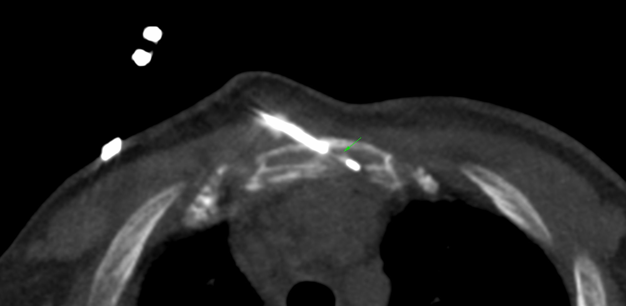 Case 14: Manubrial Sternal Lesion Biopsy