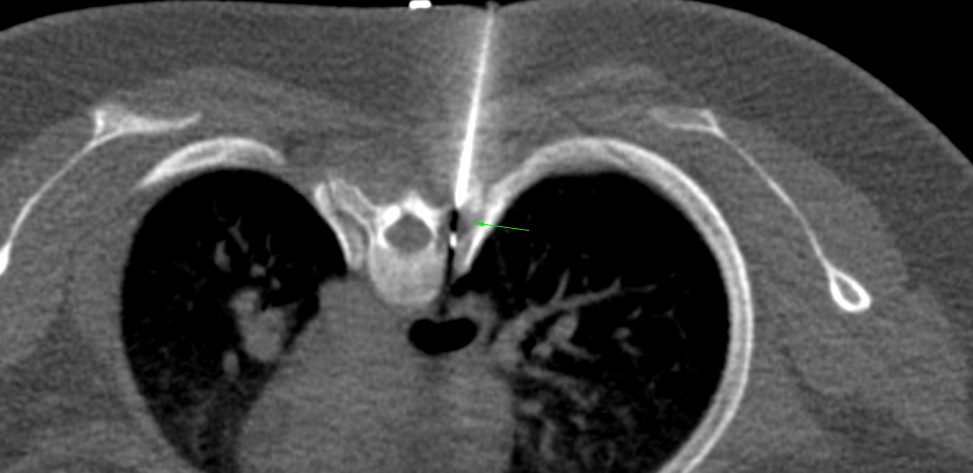 Case 11: D3 Spinal Transverse Process and Pedicle Biopsy