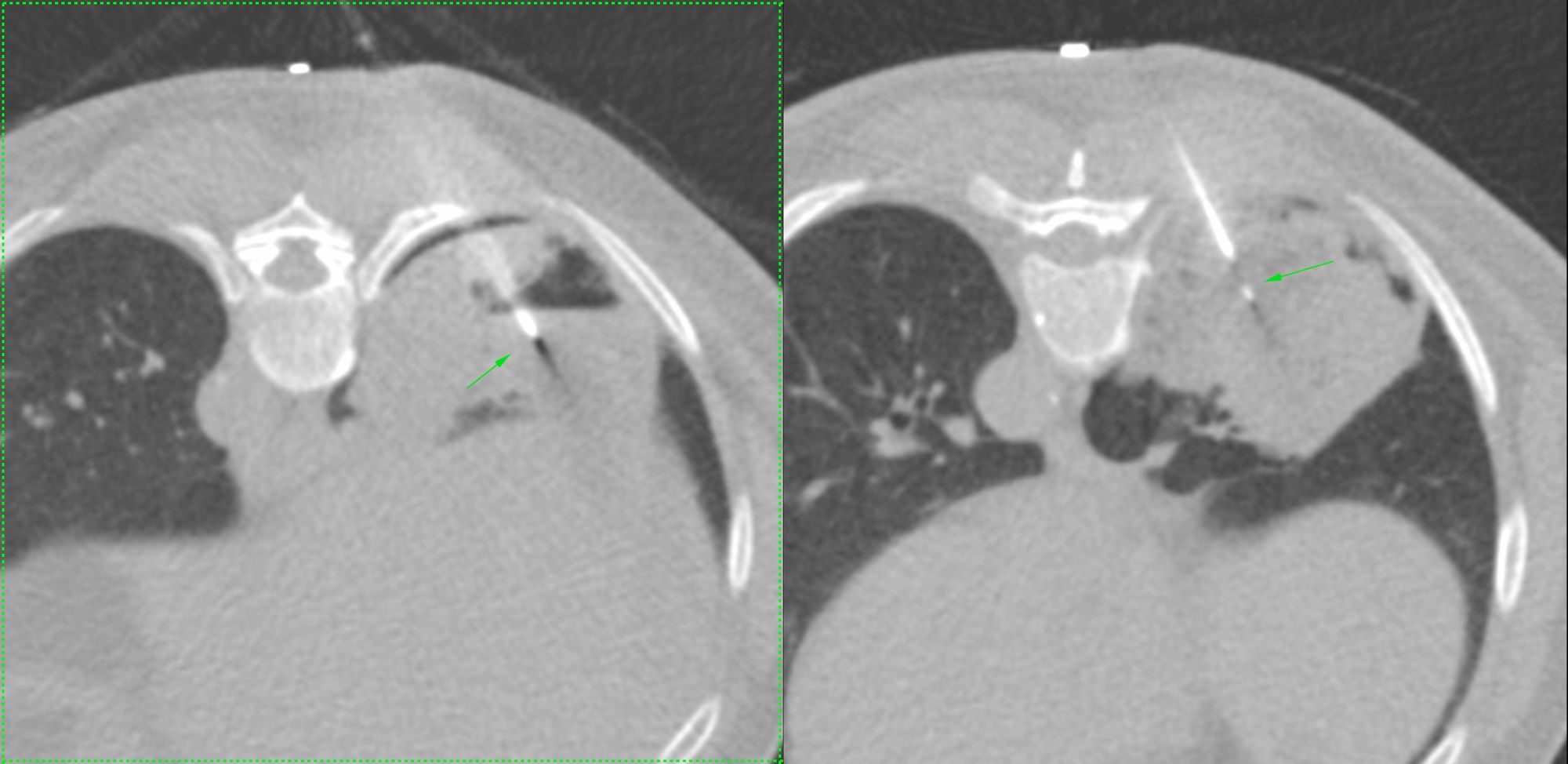 Case 18: Non-Resolving Consolidation Biopsy and Management of Entry Pneumothorax