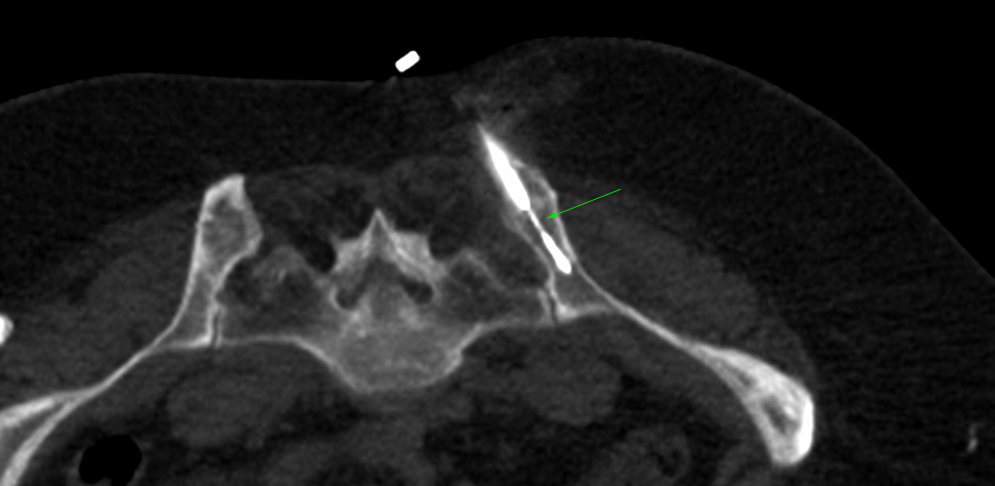 Case 12: Right Iliac Bone Biopsy - Multifocal Bone Lesions