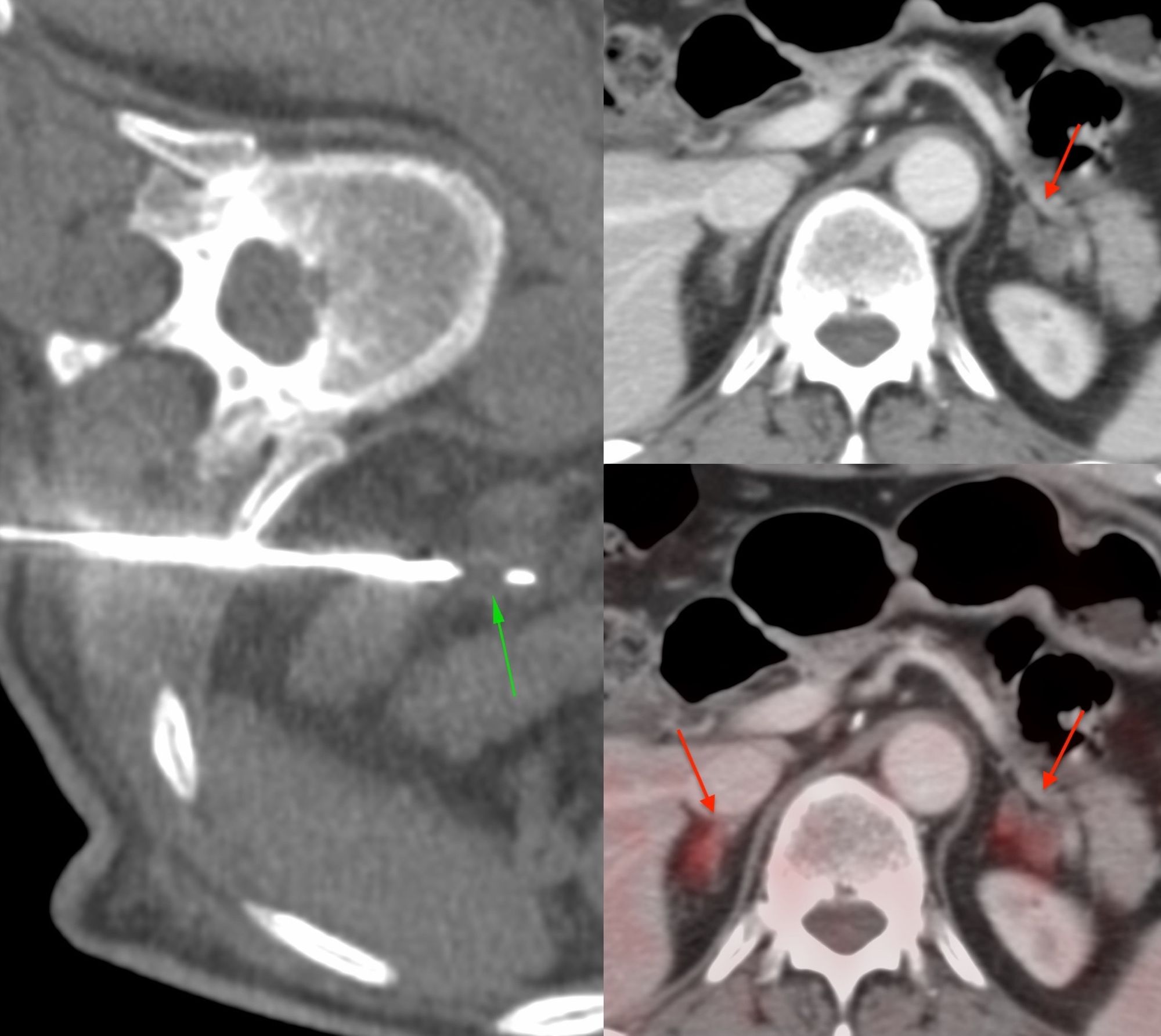 Case 21: 11.6 mm Adrenal Nodule Biopsy in the Ipsilateral Decubitus Position