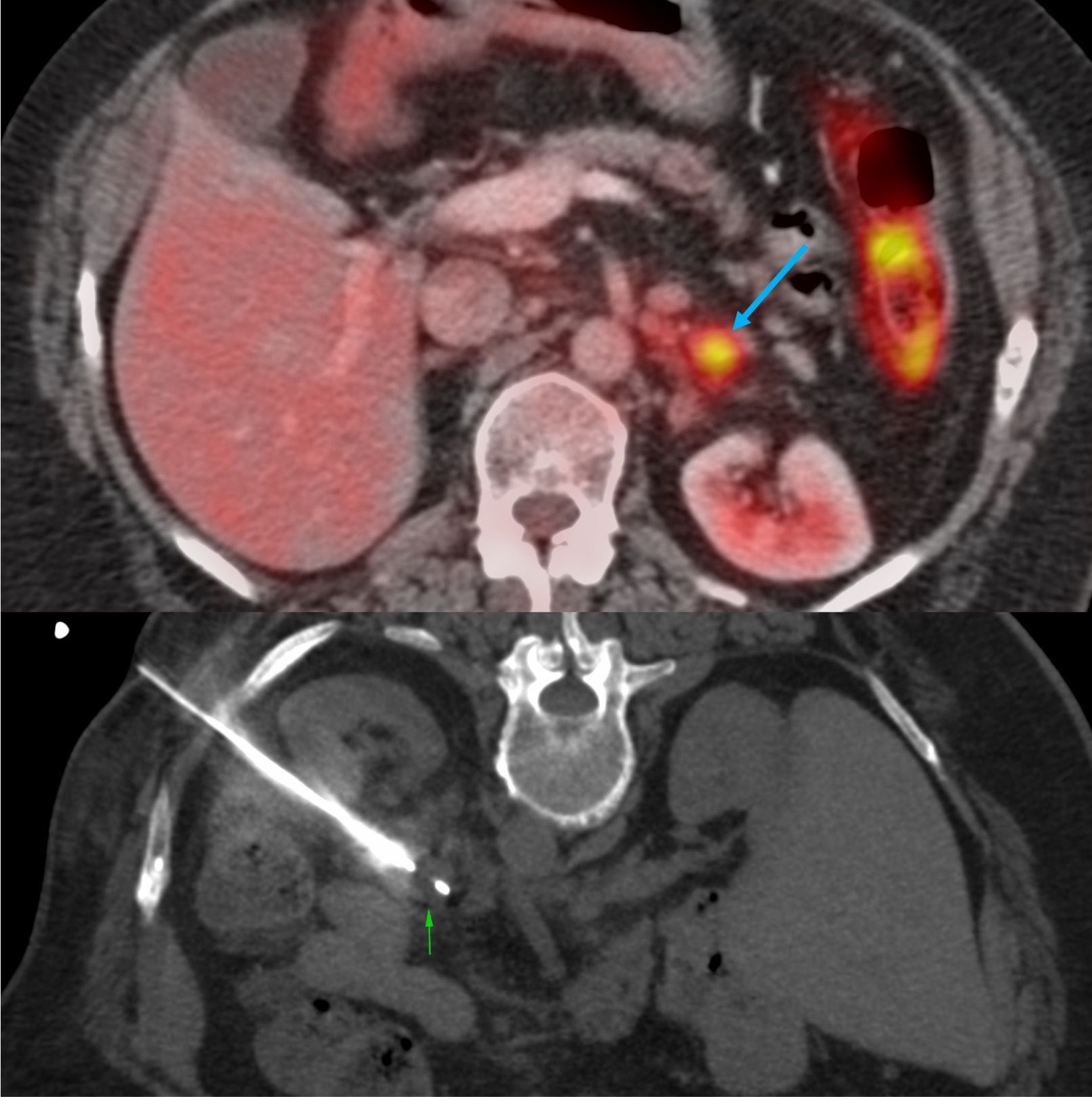 Case 22: 70-Years Lady with a Left Adrenal Nodule - Prone Posterolateral Approach