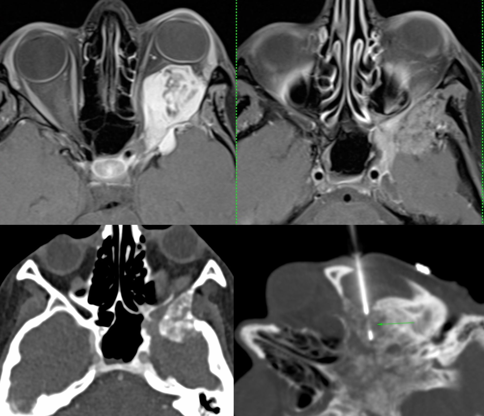 Case 23: Biopsy of Greater Wing of Sphenoid in a 25-Years Old for Recurrent Adenoid Cystic Carcinoma