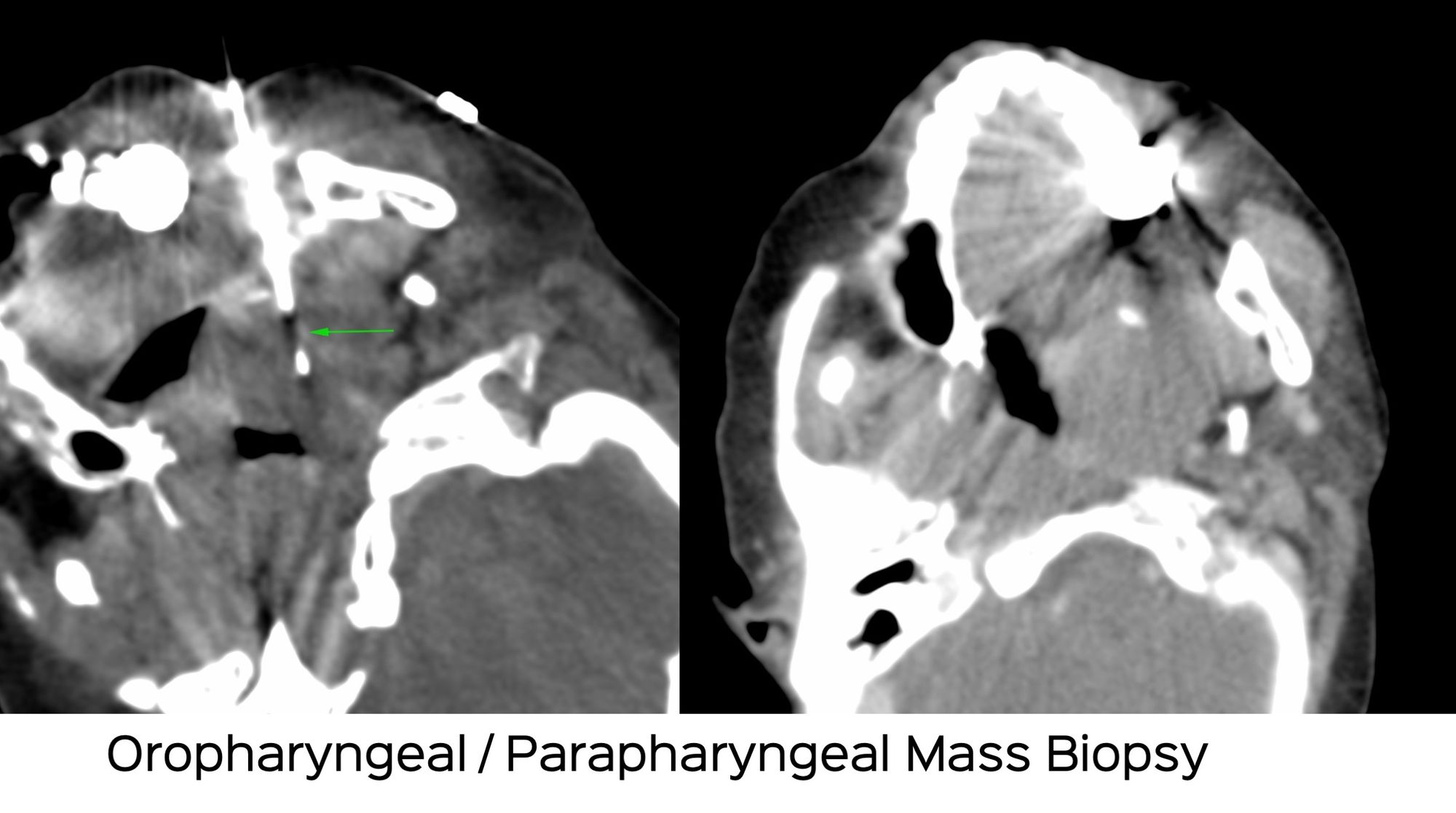 Case 24: Oropharyngeal / Parapharyngeal Mass Biopsy