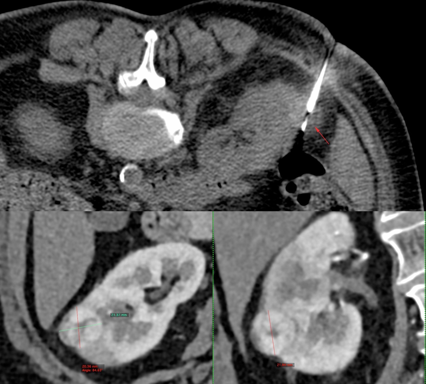 Case 20: 2.1 cm Renal Mass Biopsy