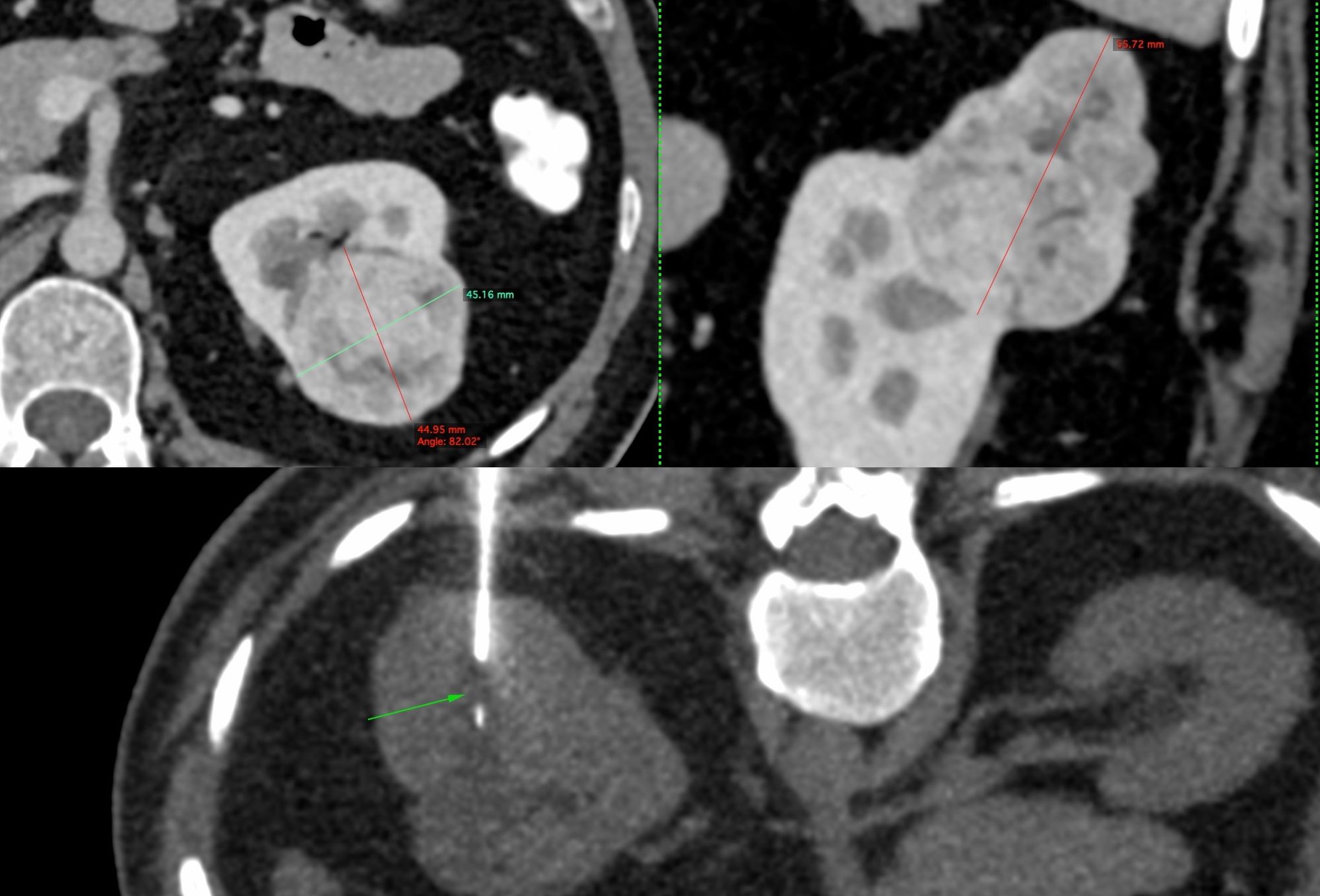 Case 19: 5.6 cm Renal Mass Biopsy