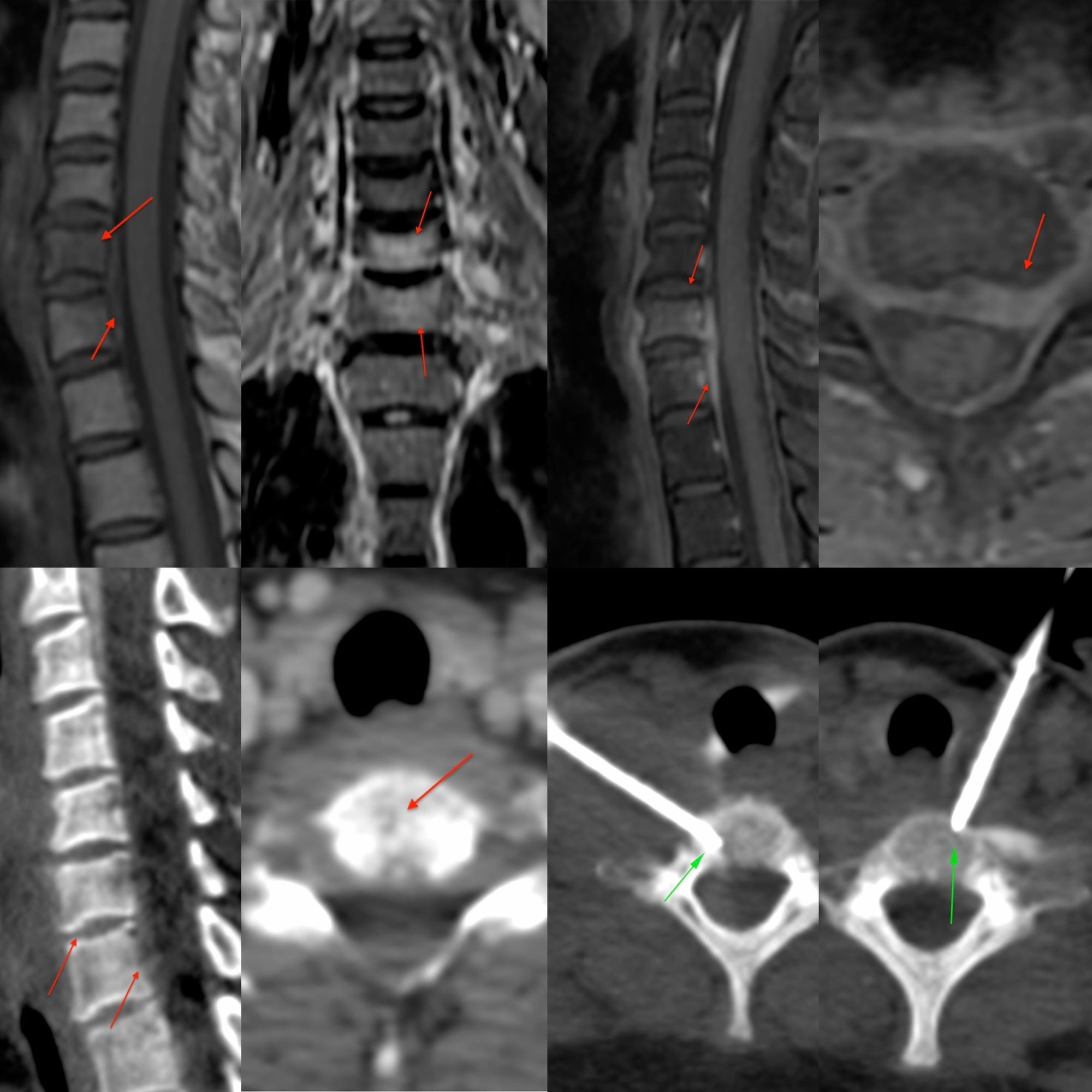 Case 26: 2nd Case - Trans-Thyroid Cervical Spine Biopsy for Infectious Disciitis