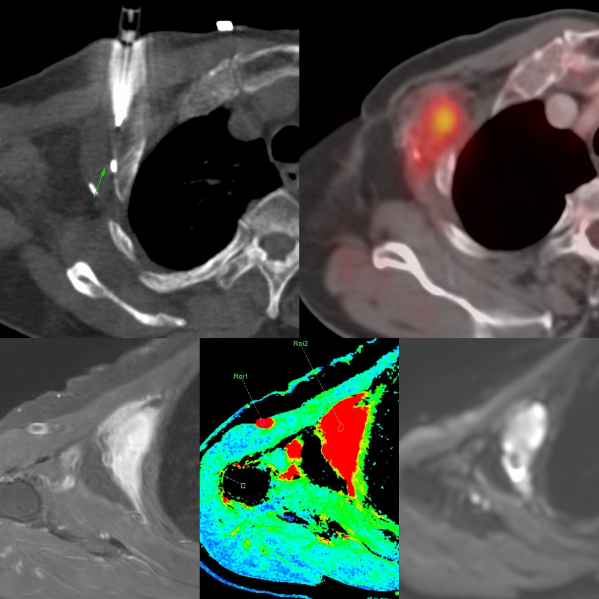 Case 27: Adipocytic Tumor Right Axilla / Chest Wall