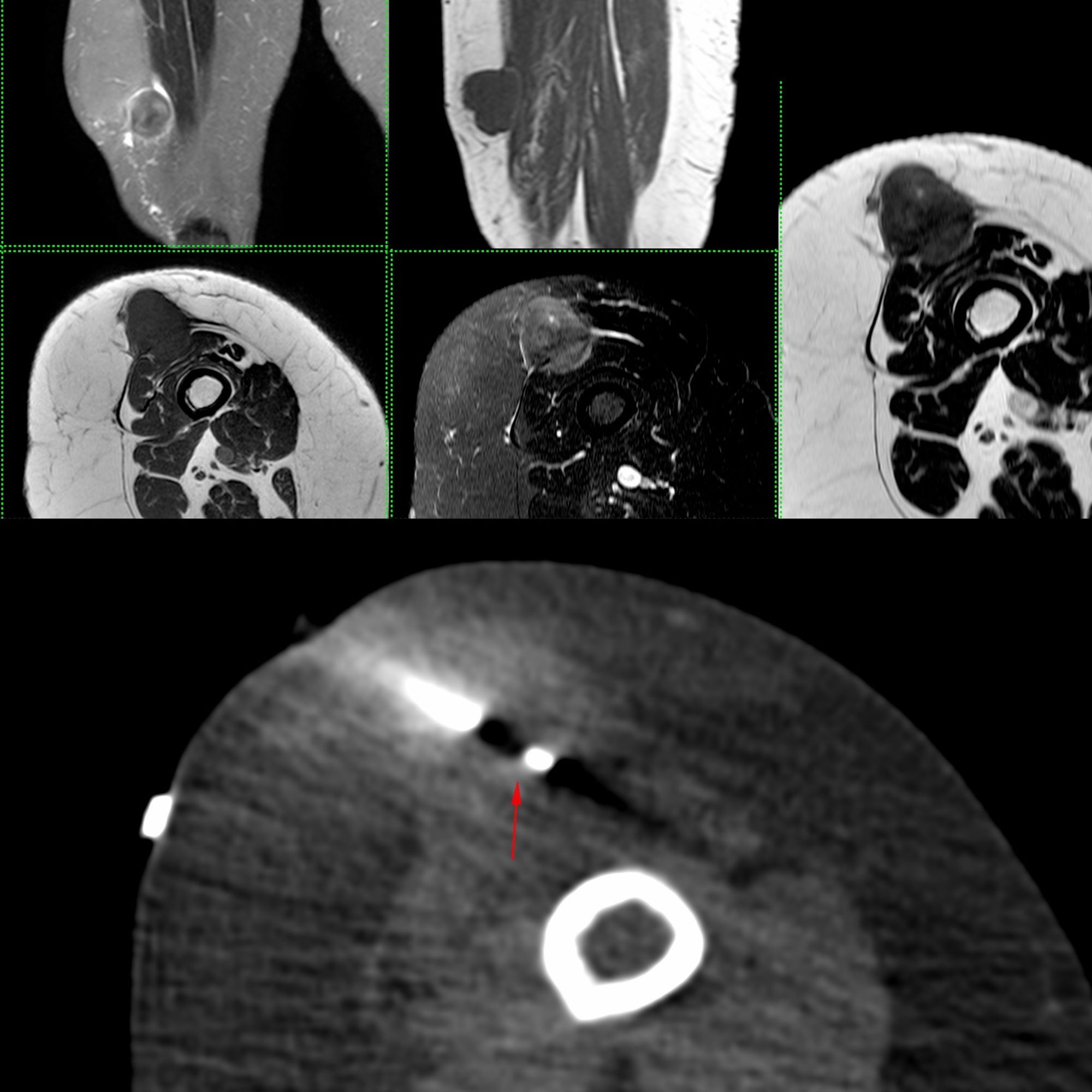 Case 28: Adipocytic Tumor Thigh - High Grade Liposarcoma