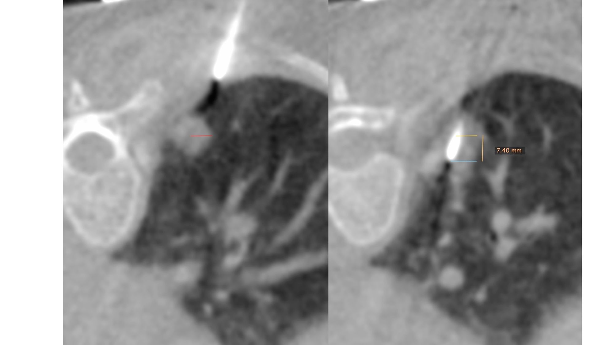 Case 35: Spearing a Moving Lung Nodule