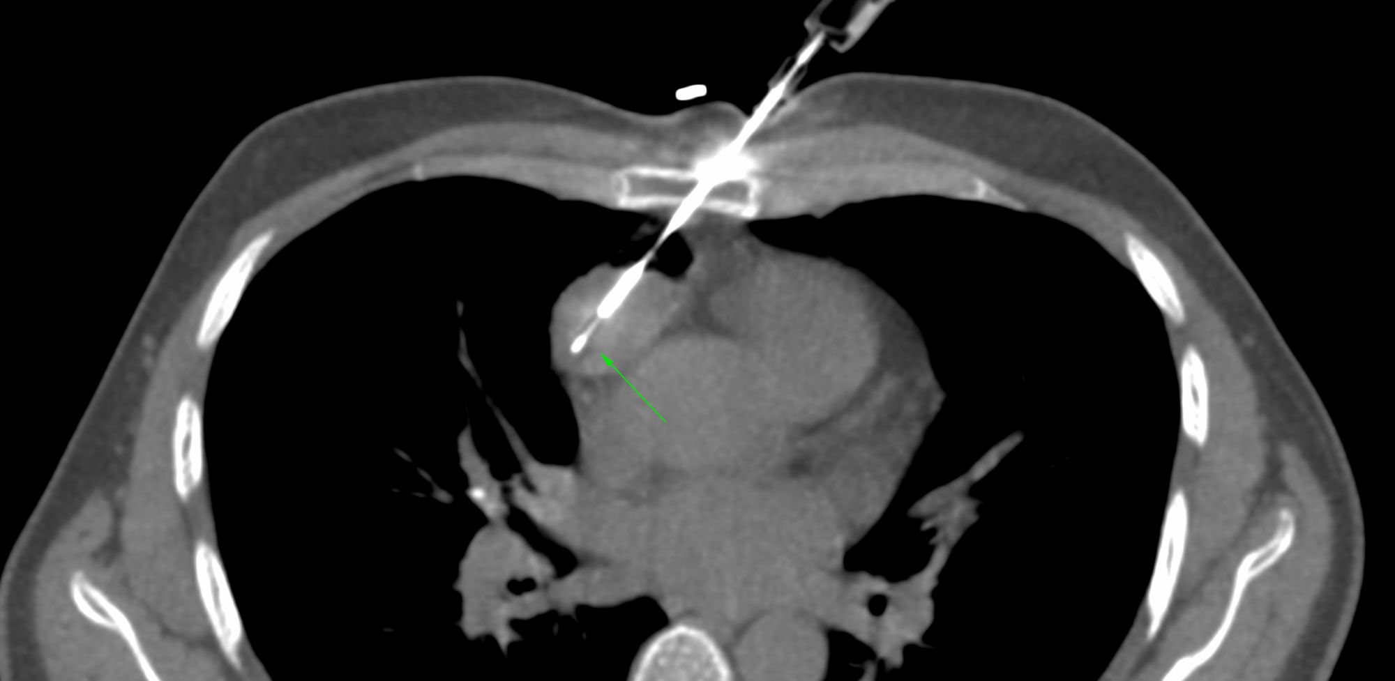 Case 37: Transsternal, Transpulmonary Biopsy of a Prevascular Space Mediastinal Mass