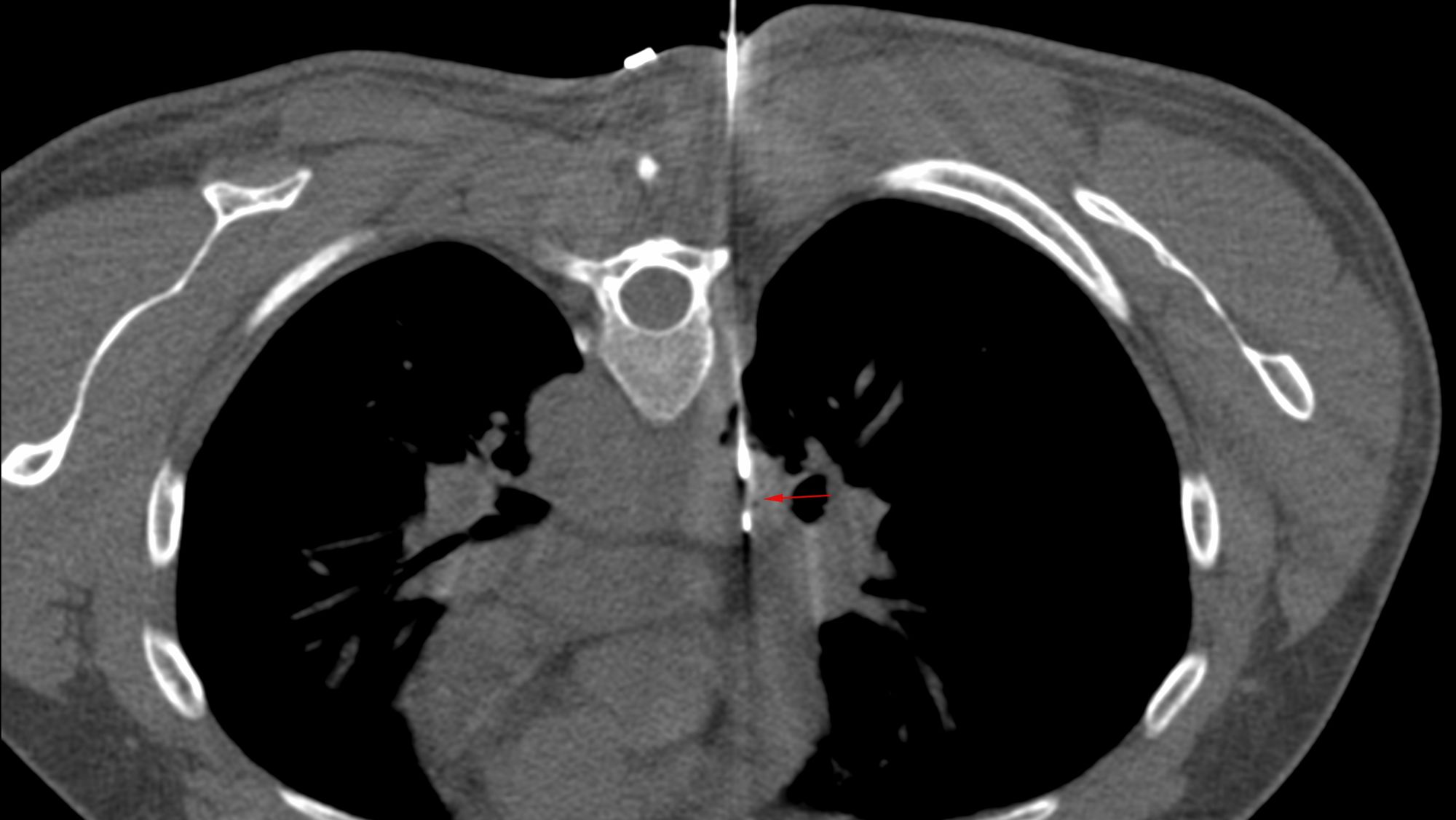 Case 31: Subcarinal Node Biopsy - Transpulmonary Approach