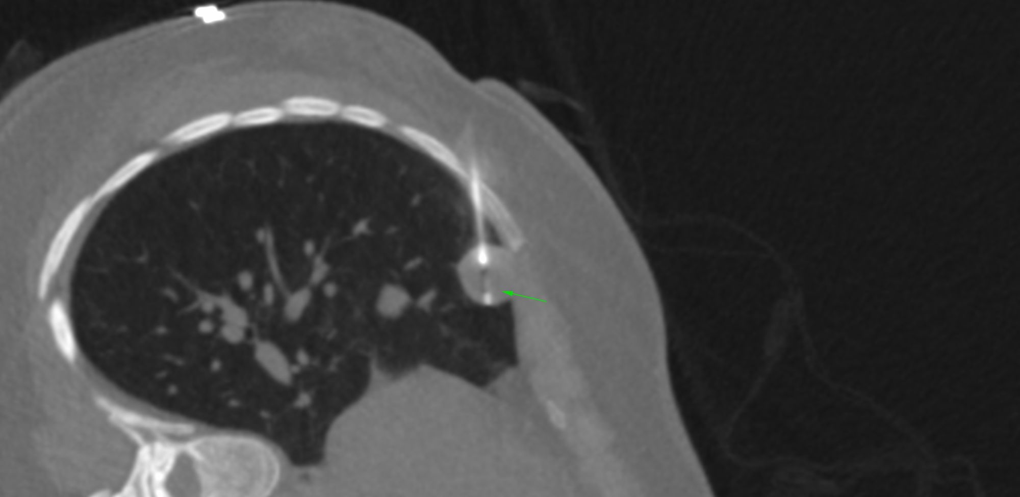 Case 34: 18 mm Right Middle Lobe Subpleural Lung Nodule - Decubitus Approach