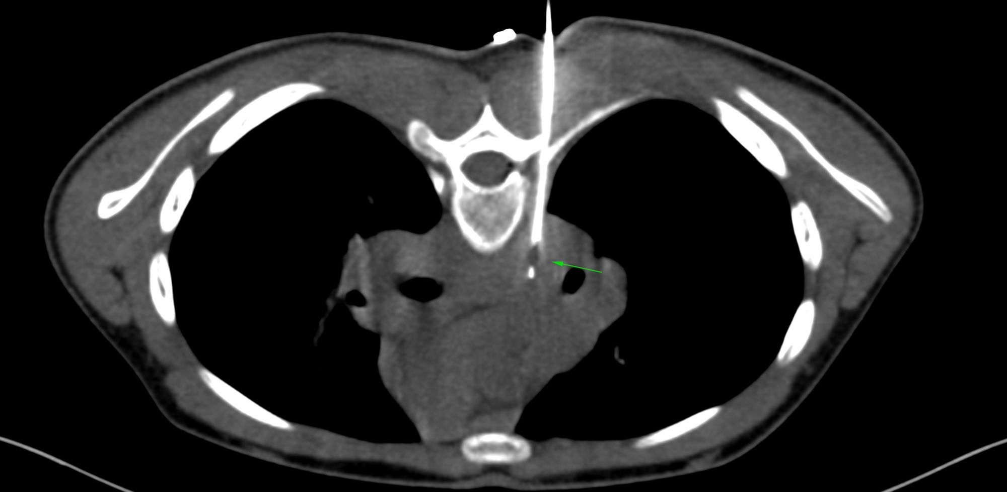 Case 30: Subcarinal Node Biopsy - Extrapleural Approach