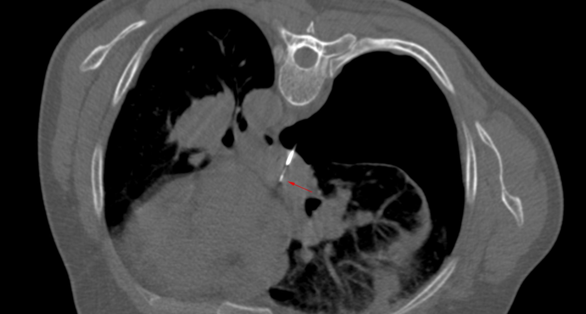 Case 32: Subcarinal Node Biopsy - Transpleural Approach - Pre-Existing Pneumothorax