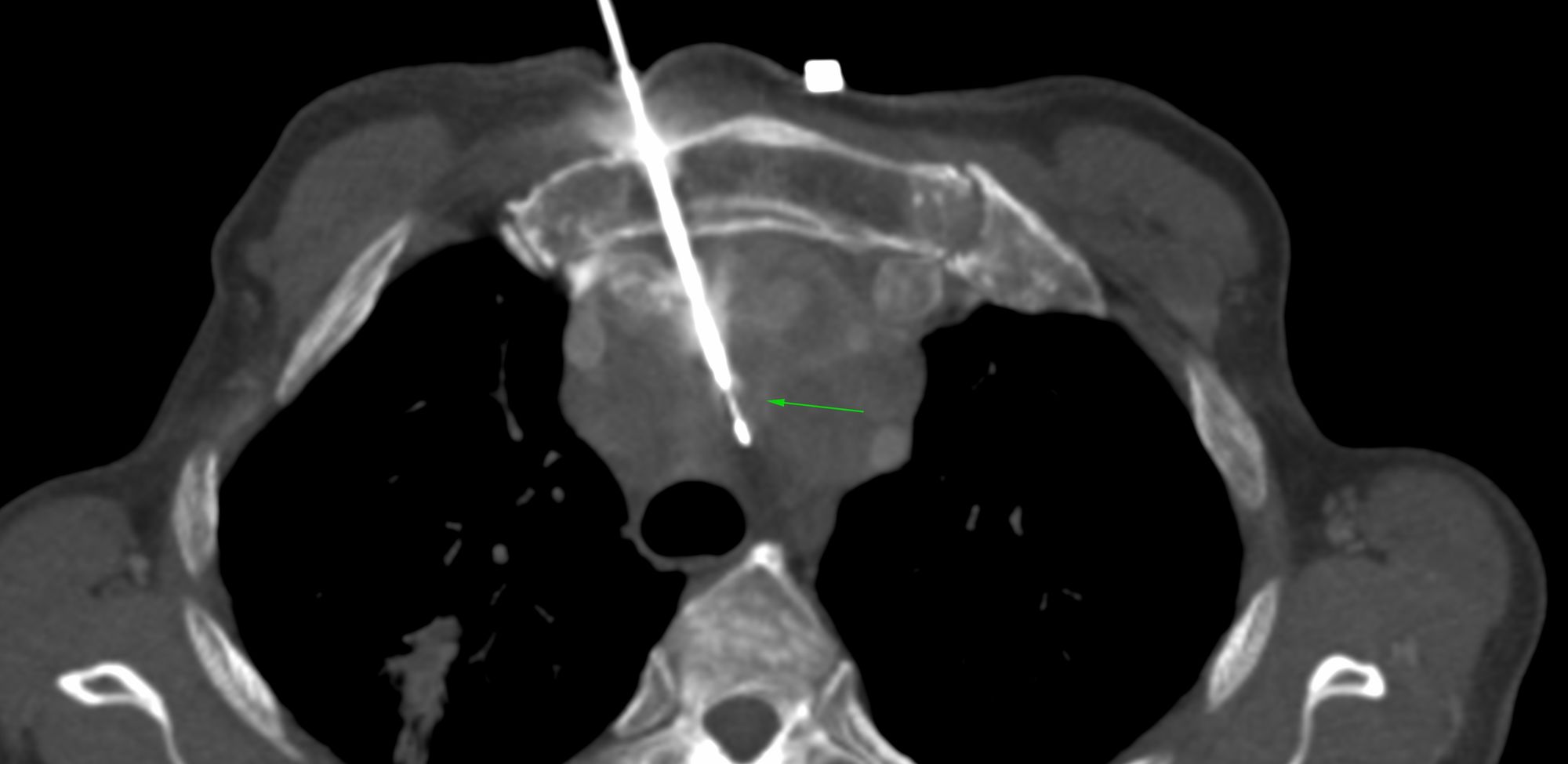 Case 38: Transsternal Biopsy of a Pretracheal Space Mediastinal Mass