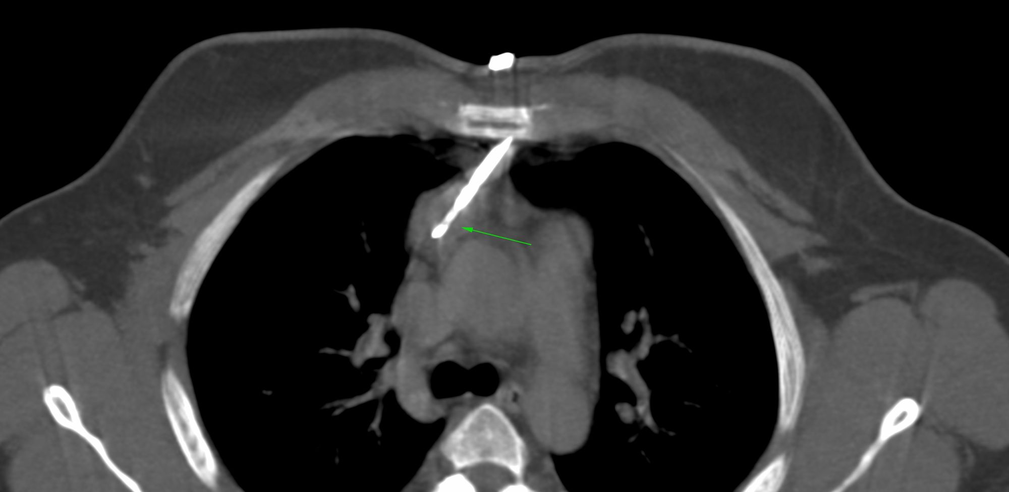 Case 36: Transsternal Biopsy of a Spontaneously Regressing Mediastinal Seminomatous Germ Cell Tumor...and Eating Humble Pie