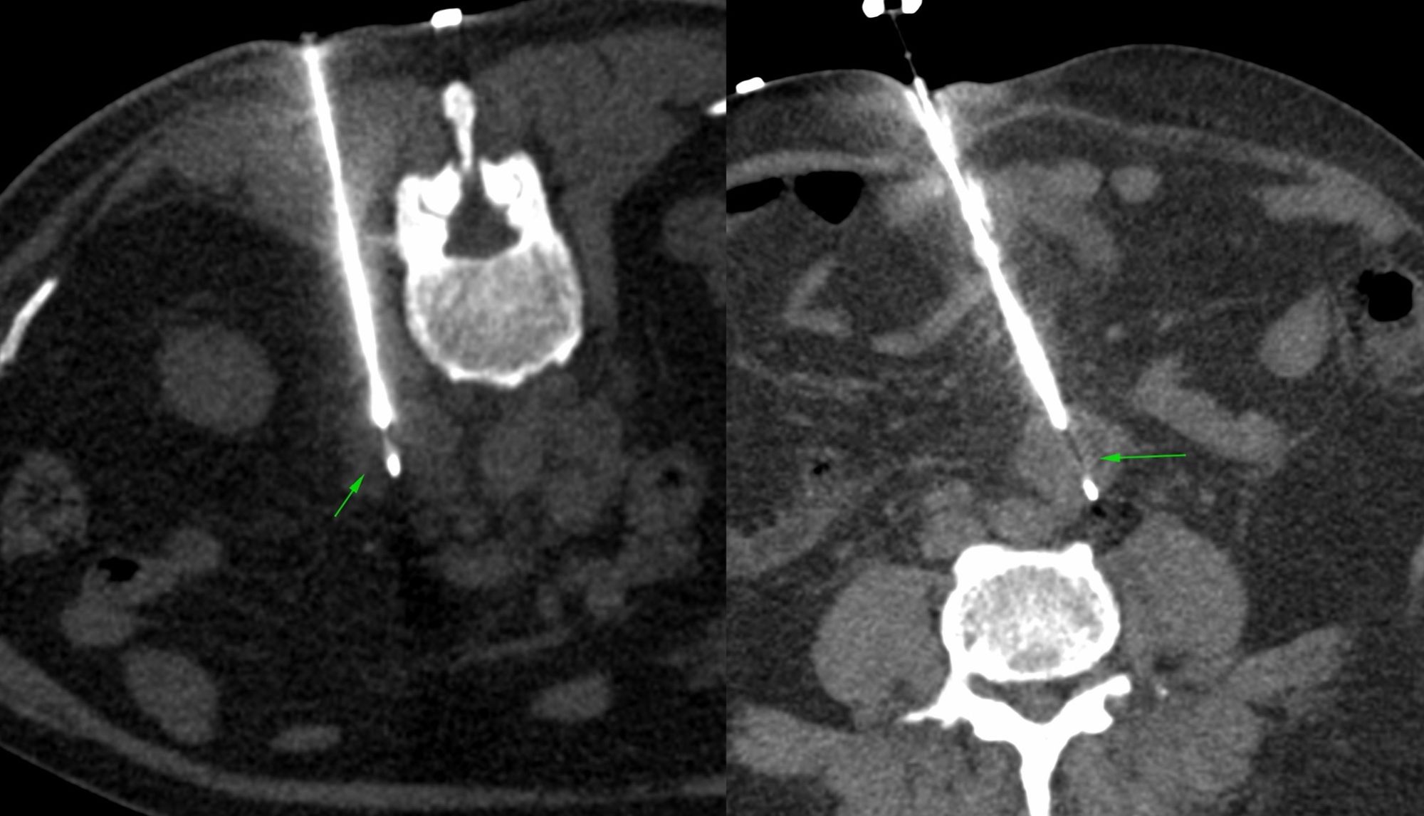 Case 43: Retroperitoneal Node Biopsy - First Prone, Then Supine