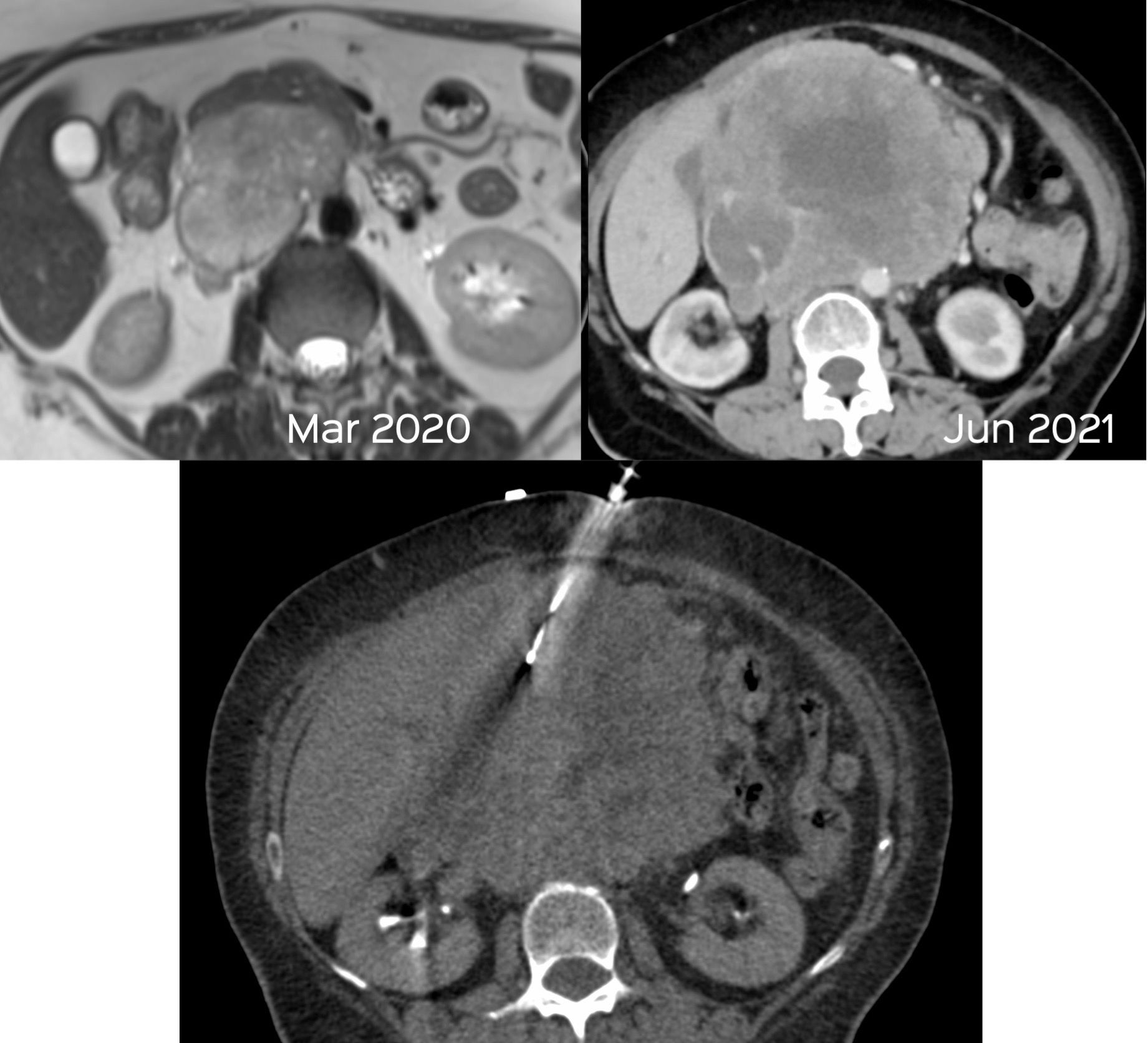 Case 44: IVC Leiomyosarcoma Biopsy – The Tragedy of “It Can’t Be Done” and “Covid-19” and "Procrastination”