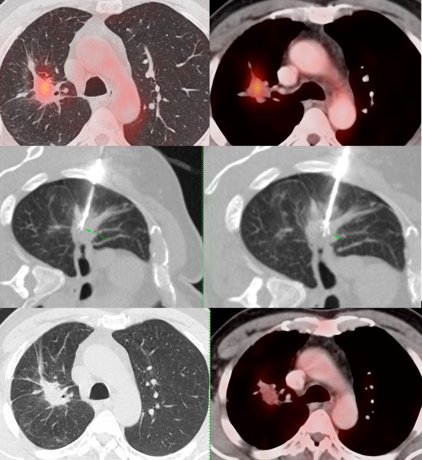 Case 41: Radiofrequency Ablation (RFA) of a Peri-Hilar Lung Mass