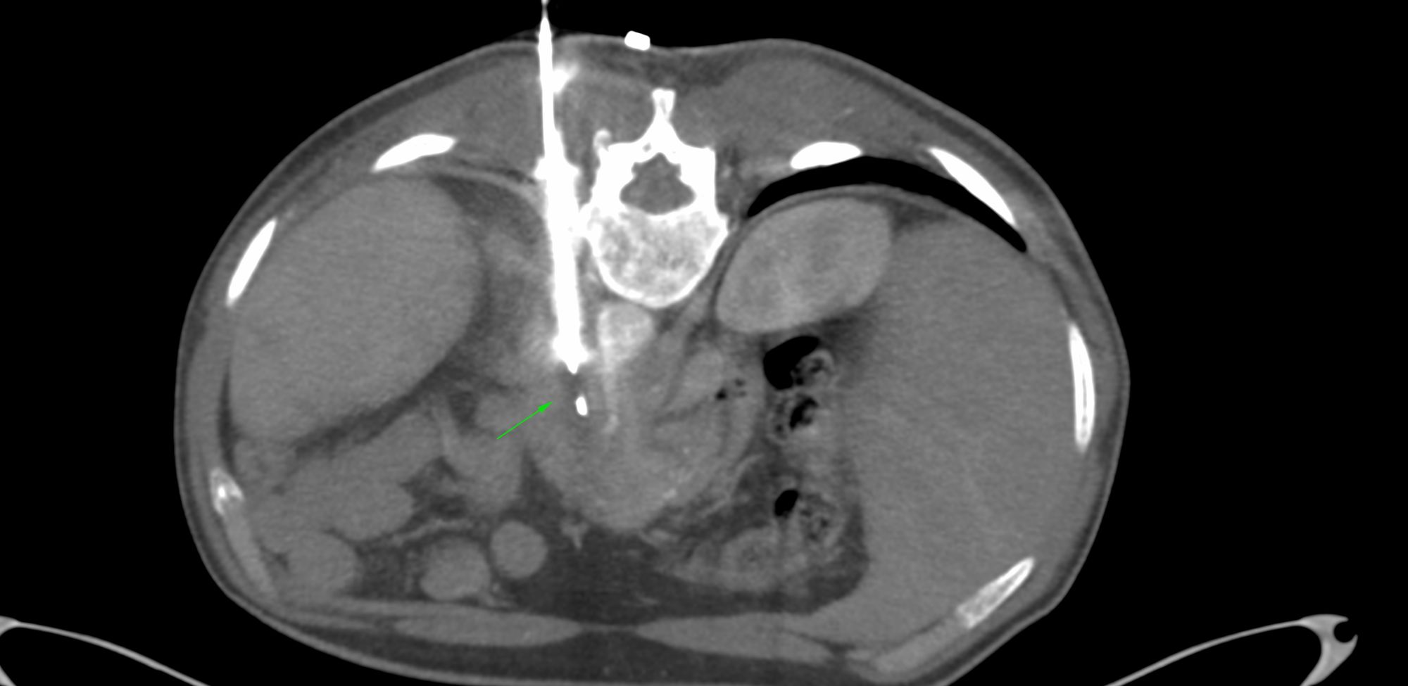 Case 42: Complex Retroperitoneal Mass with Intra-Procedural Intravenous Contrast