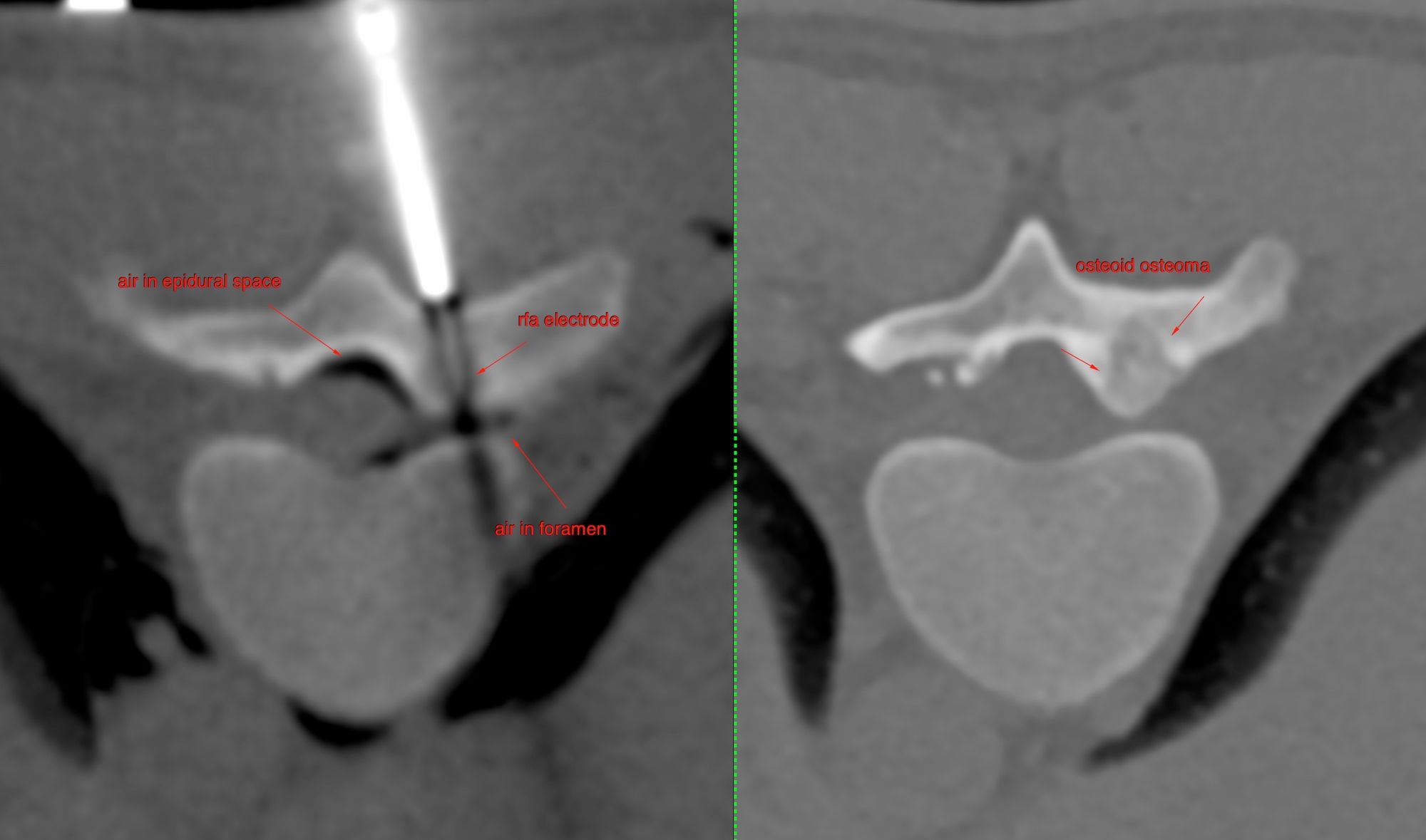 Case 40: Radiofrequency Ablation (RFA) of D10 Pars Osteoid Osteoma