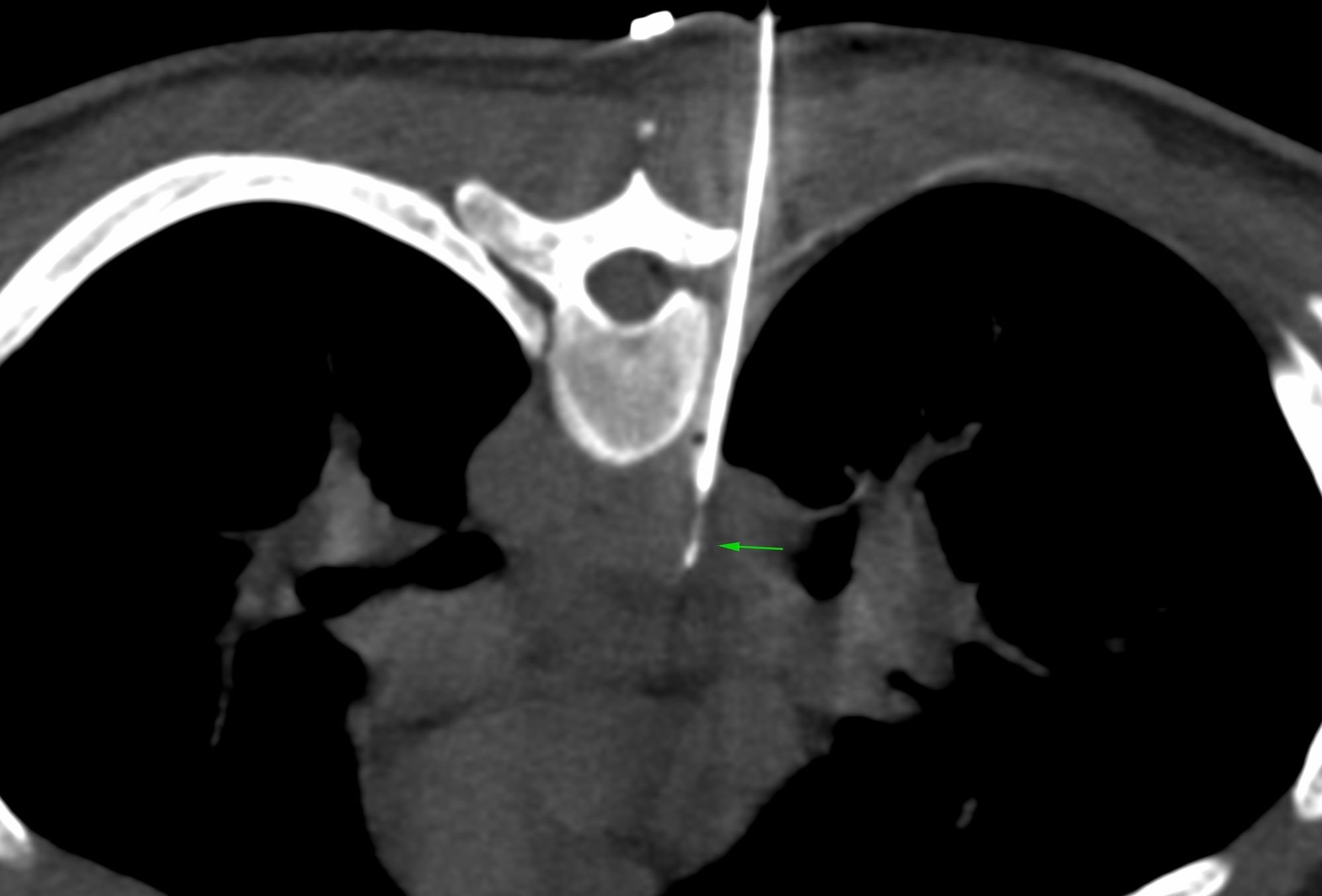 Case 45: Subcarinal Node Biopsy…and The Six Weeks Conundrum