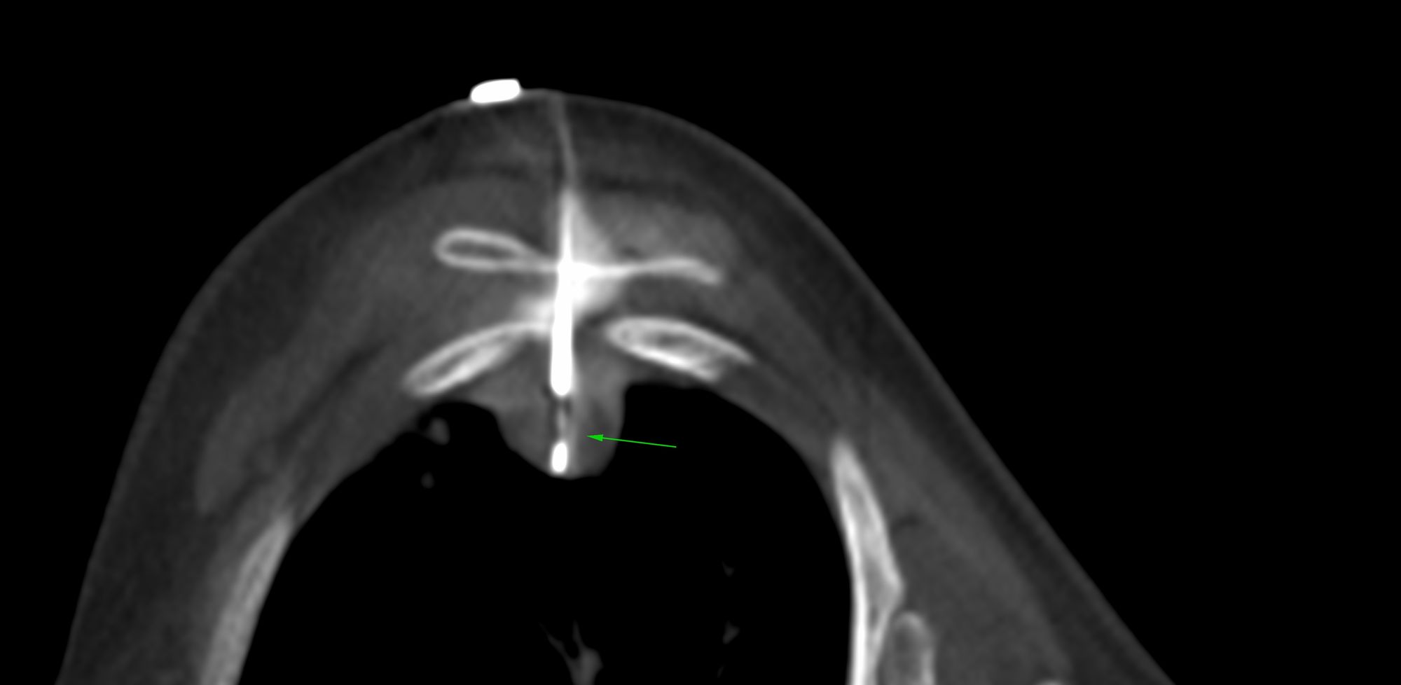 Case 39: Transscapular Biopsy of a Loculated Pleural Collection