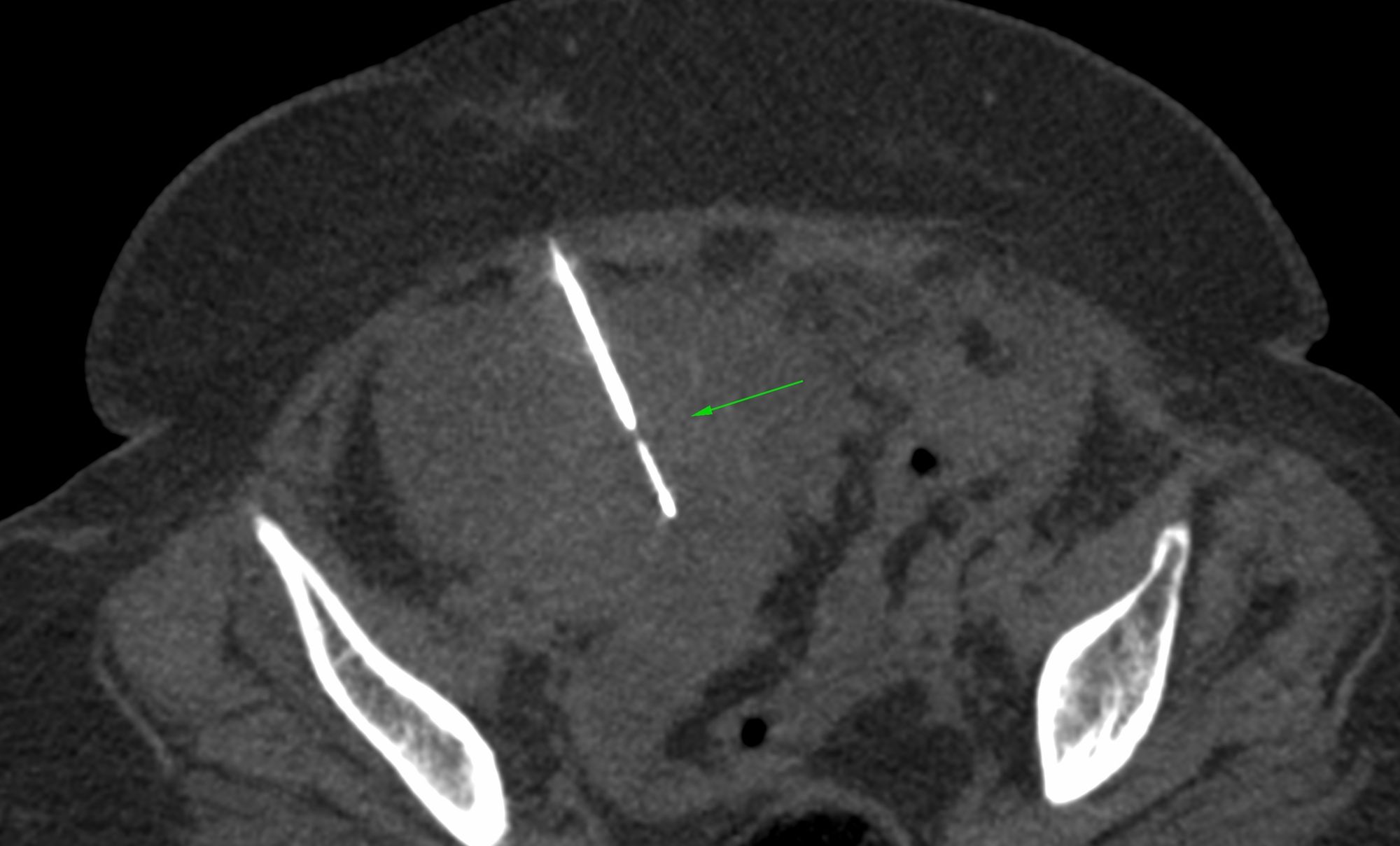 Case 47: Ovarian Mass Biopsy - Serous Adenocarcinoma