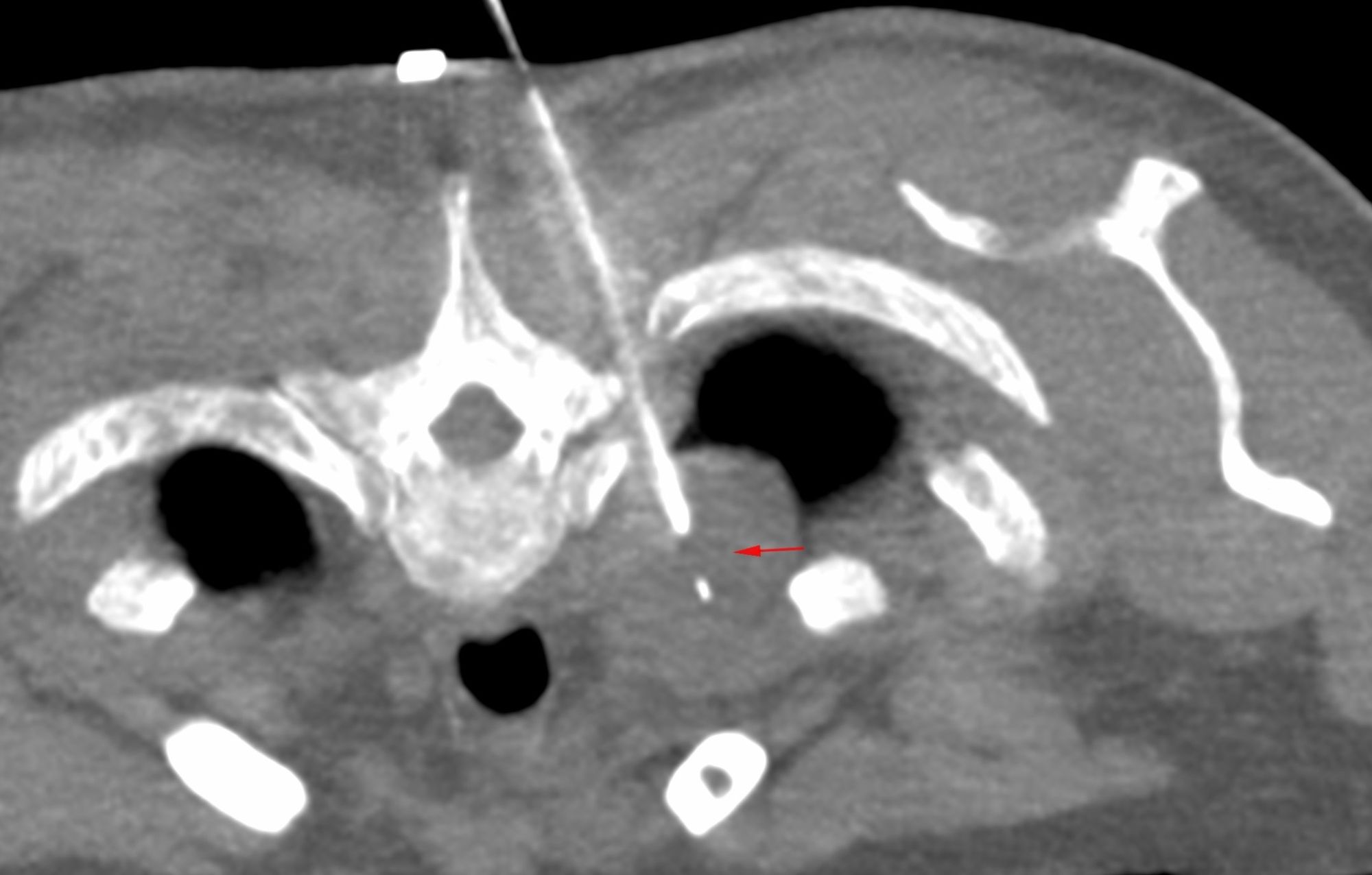 Case 51: When Just “Touching” the Lesion Gives an Answer – Apical Hemithorax Schwannoma