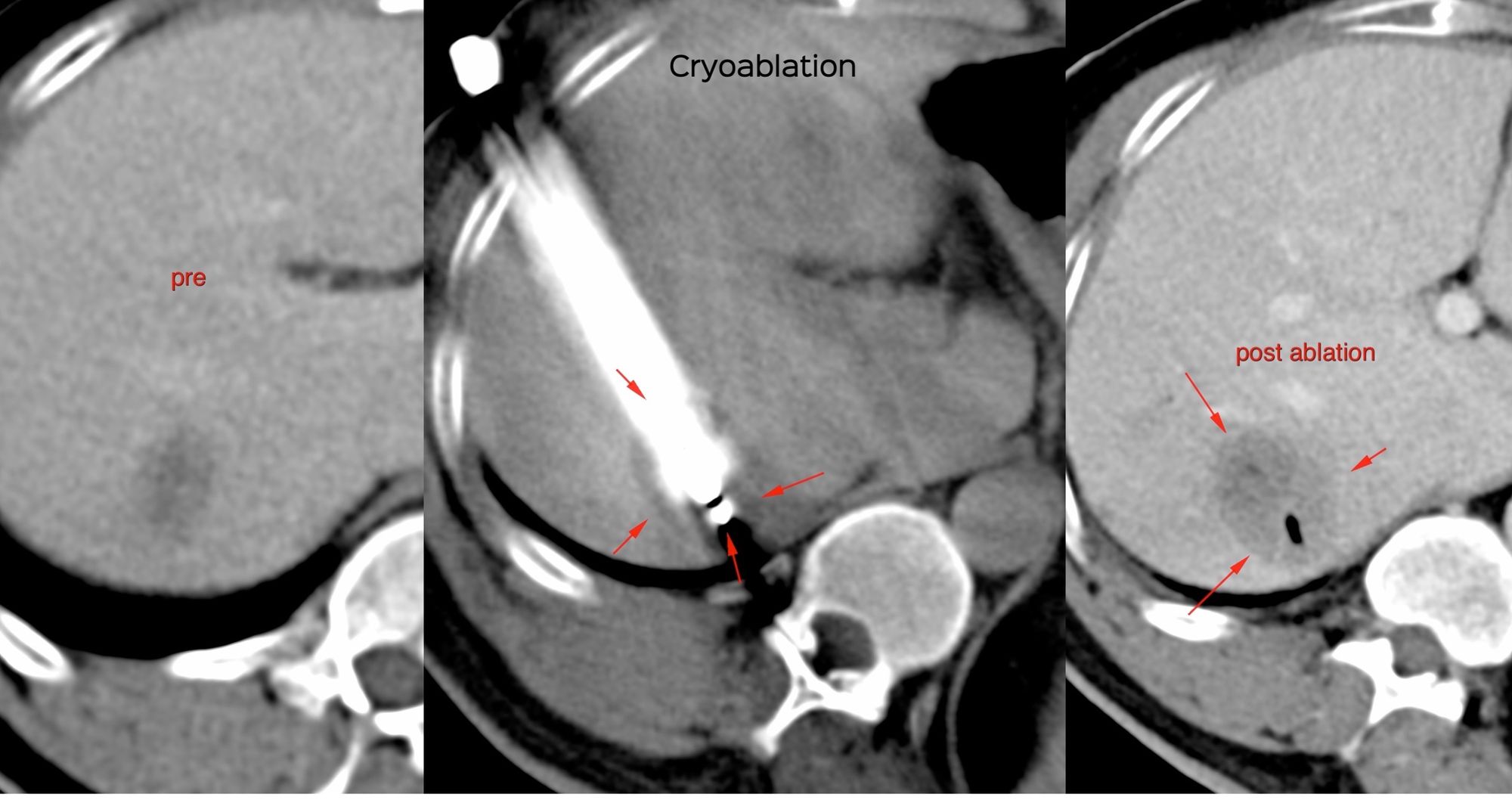 Case 52: Cryoablation of Liver Metastasis