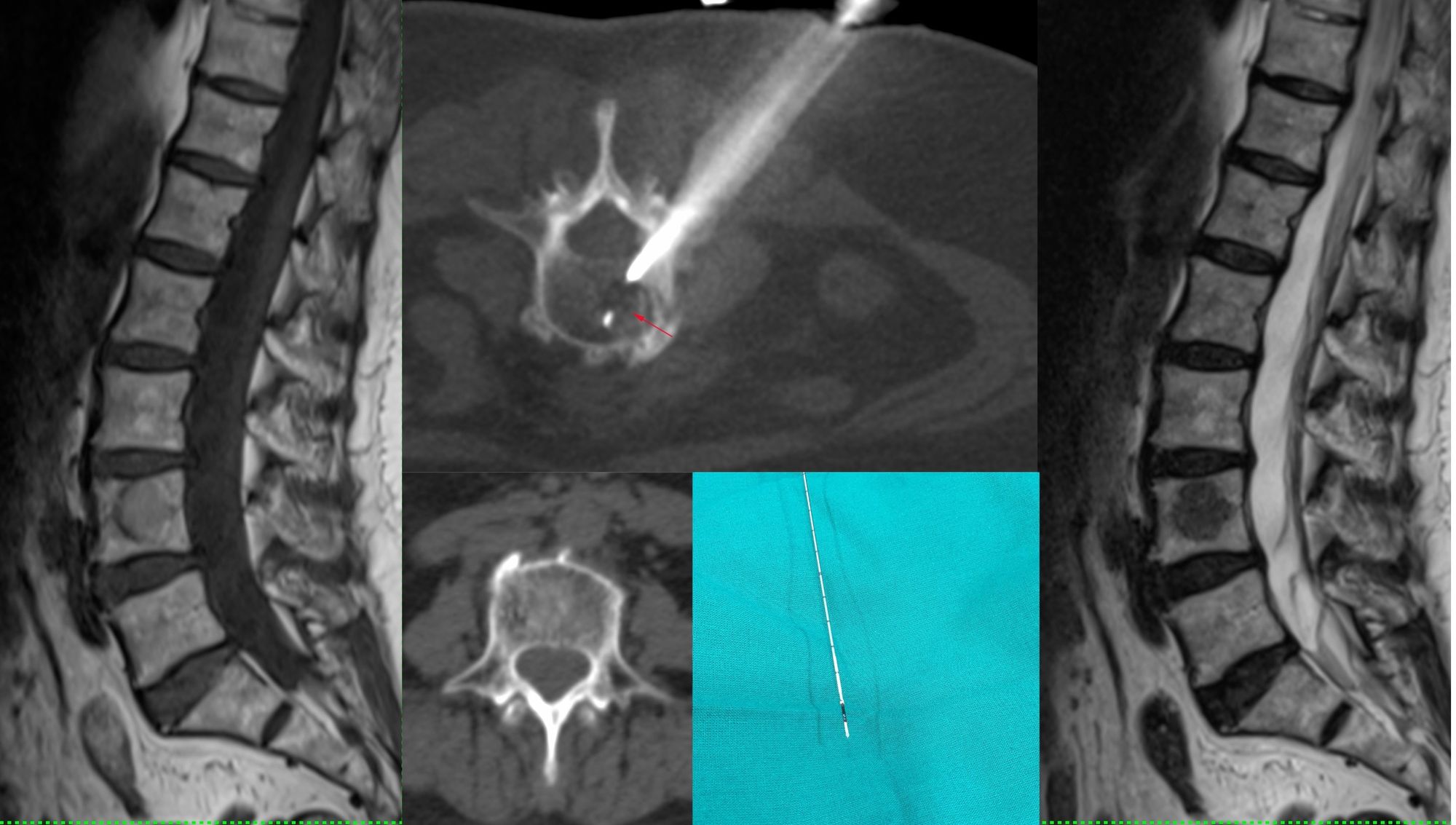 Case 49: When The Answer is in the Biopsy Material Itself – Vertebral Melanoma Metastasis