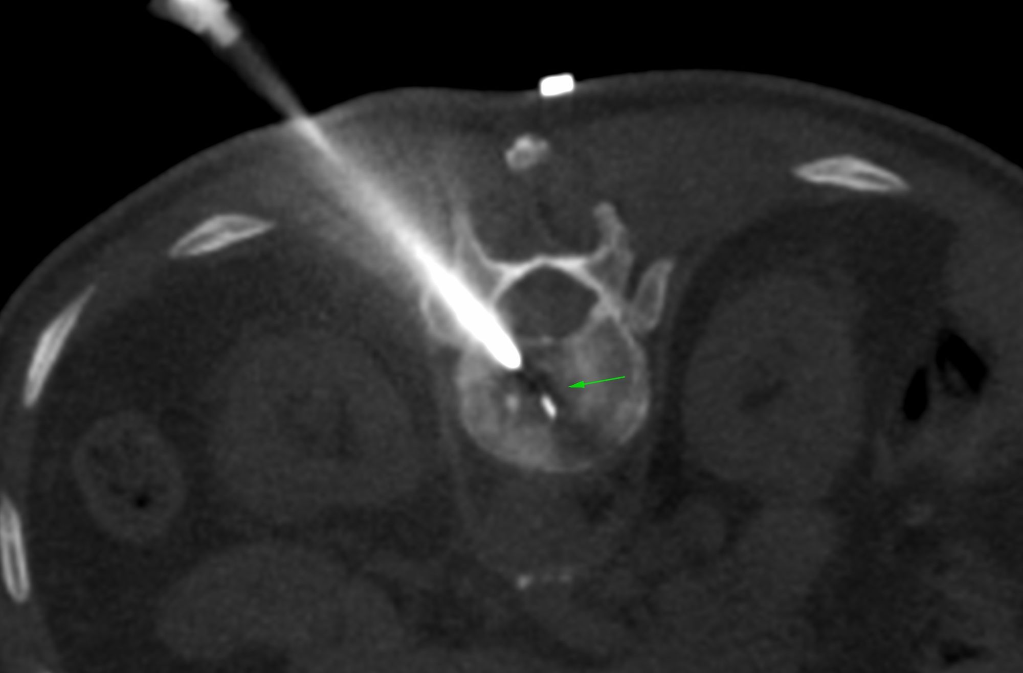 Case 46: D12 Spine Lesion Biopsy…It’s Not Always Six Weeks